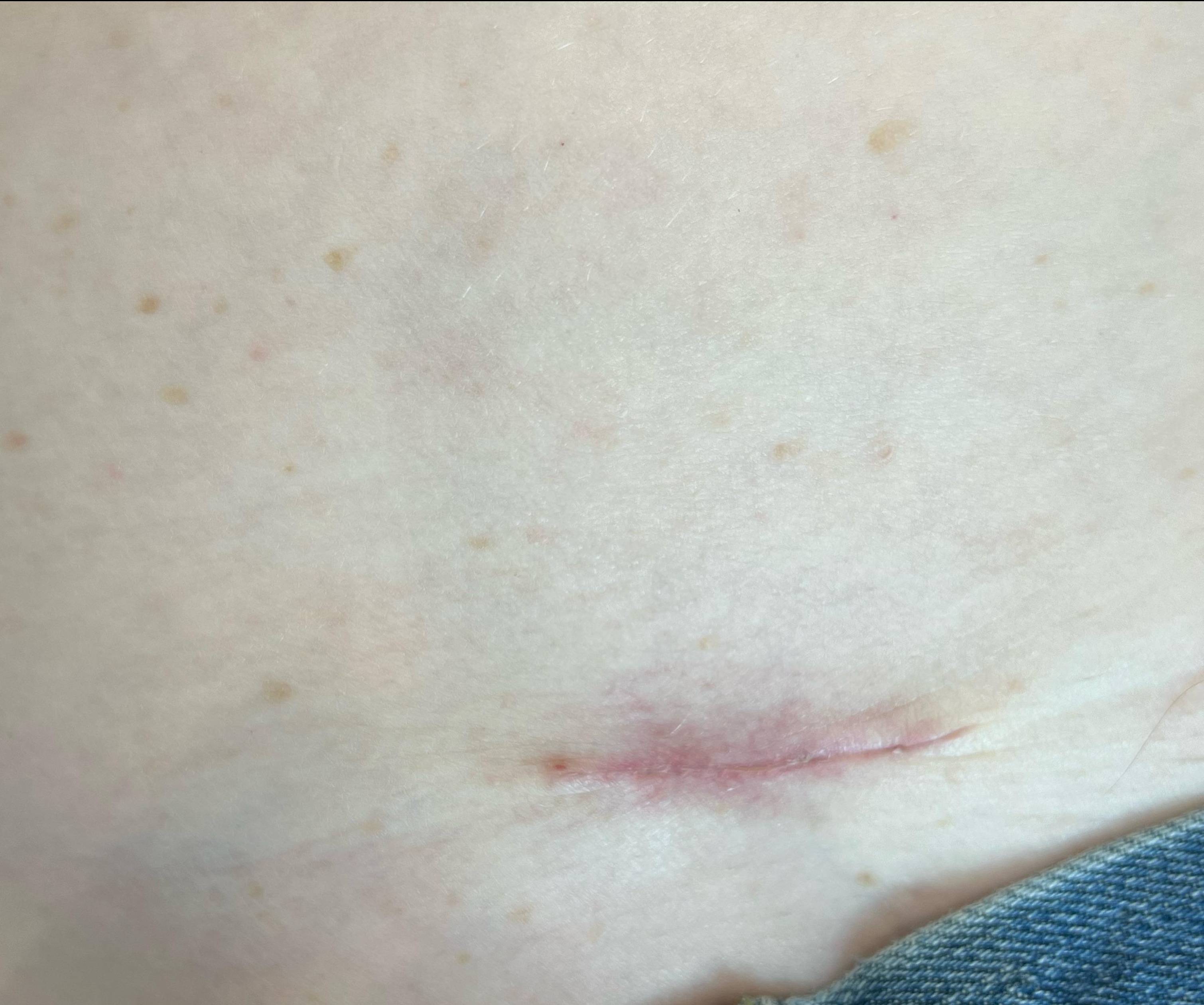 Cyst Removal Before and After Case- 78 After