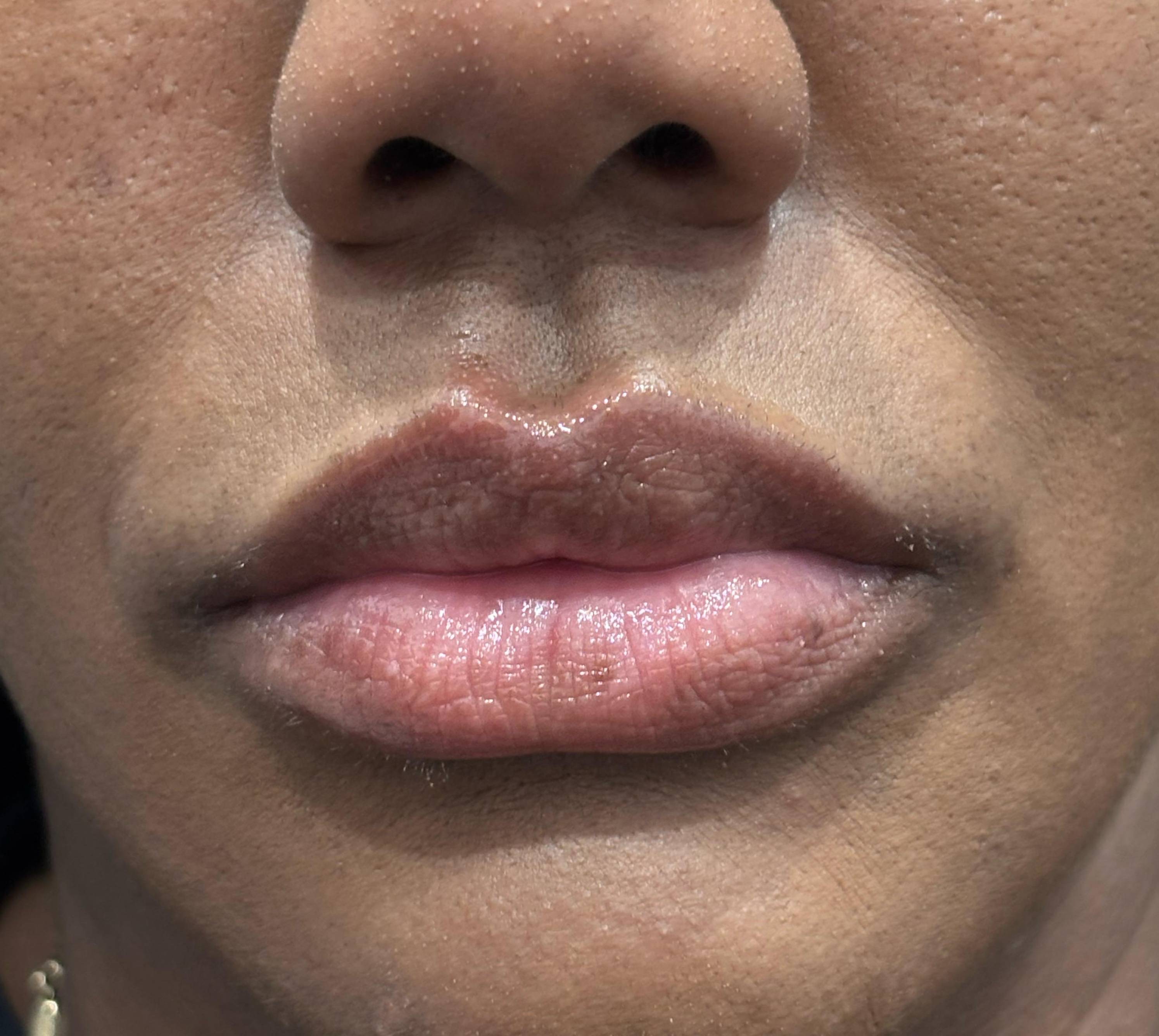 Juvederm Before and After Case- 20 After