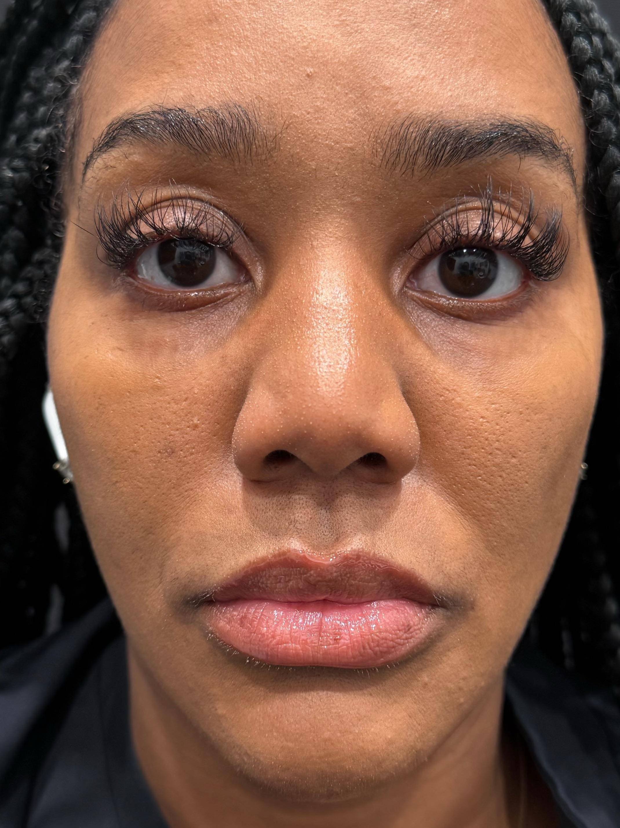 PRP Eye Before and After Case- 33 Before