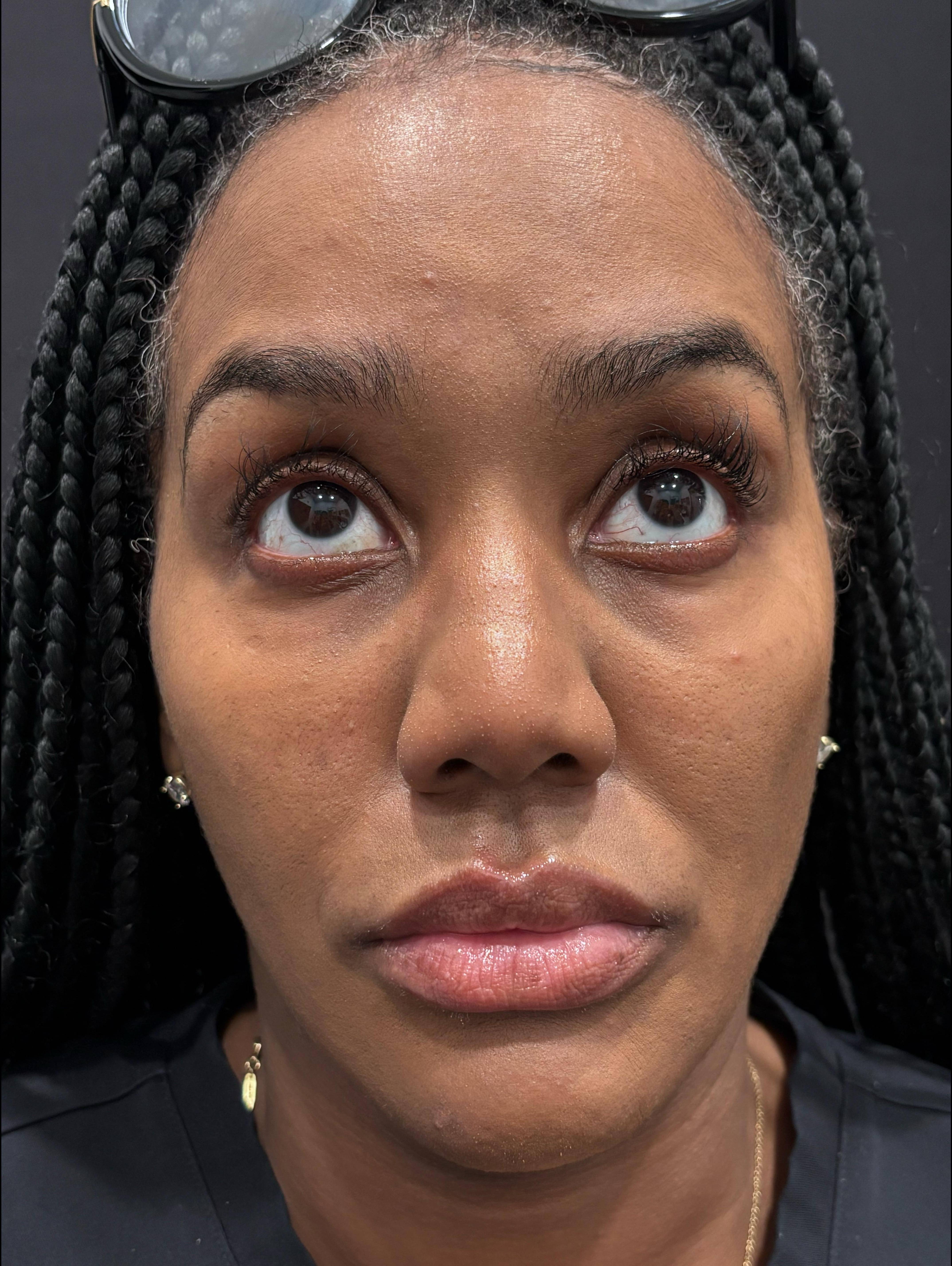 PRP Eye Before and After Case- 33 After