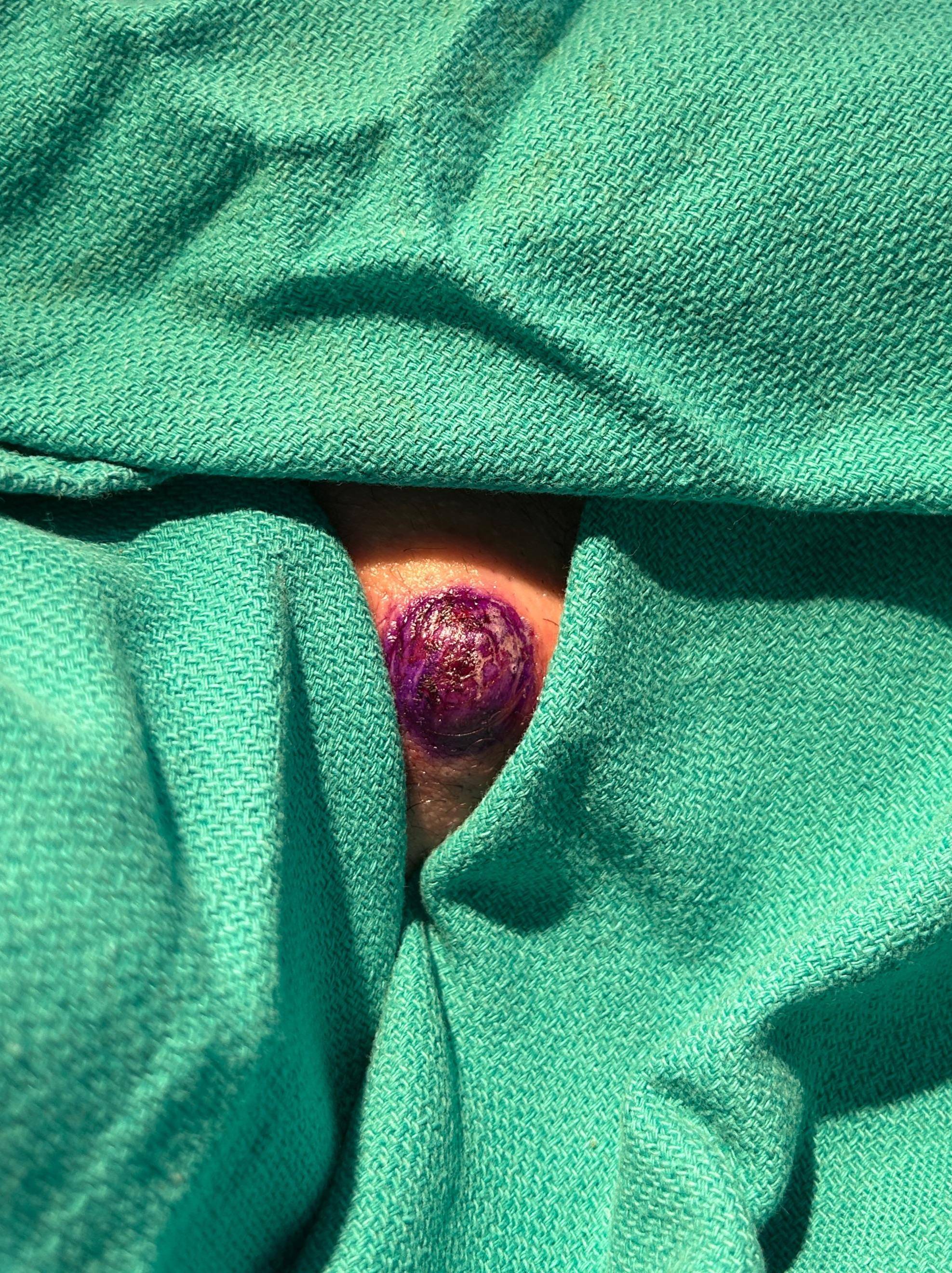 Cyst Removal Before and After Case- 79 Before