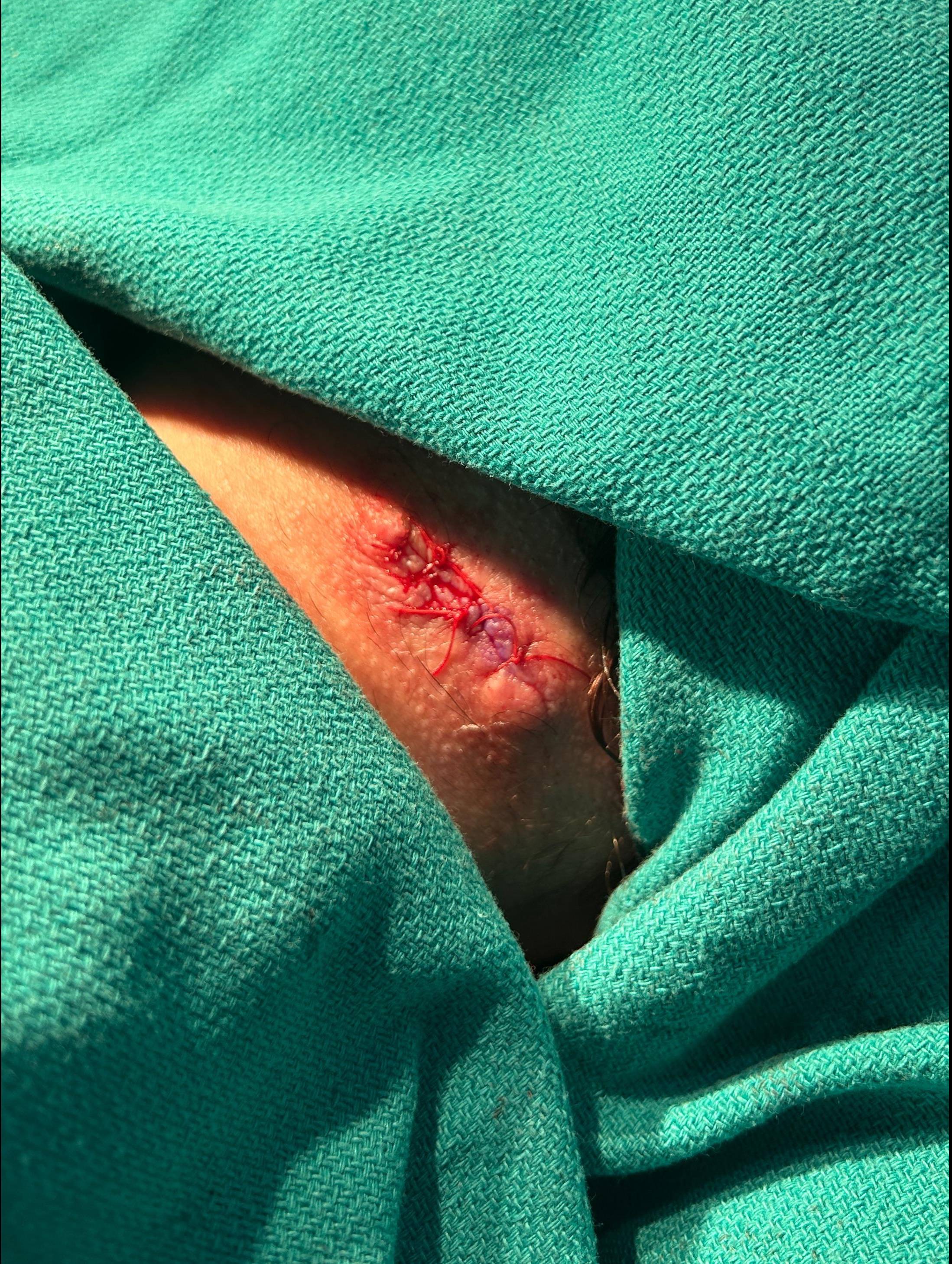 Cyst Removal Before and After Case- 79 After