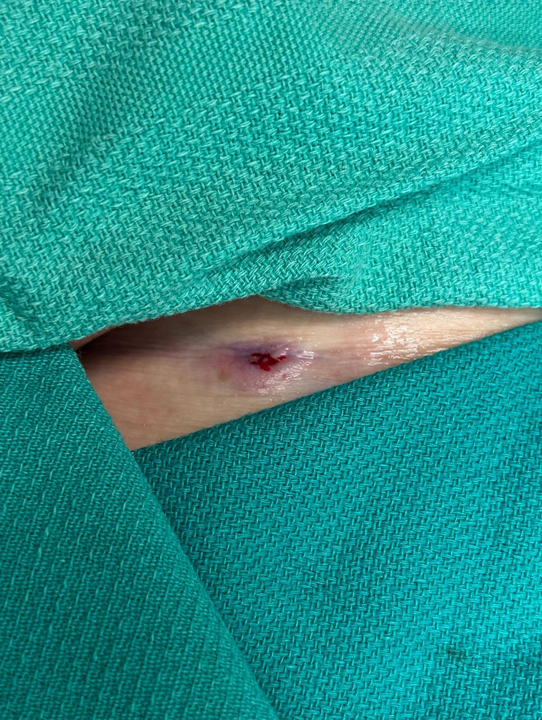 Cyst Removal Before and After Case- 80 Before