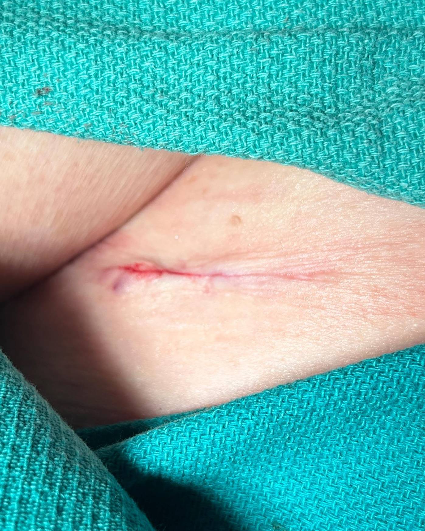 Cyst Removal Before and After Case- 80 After