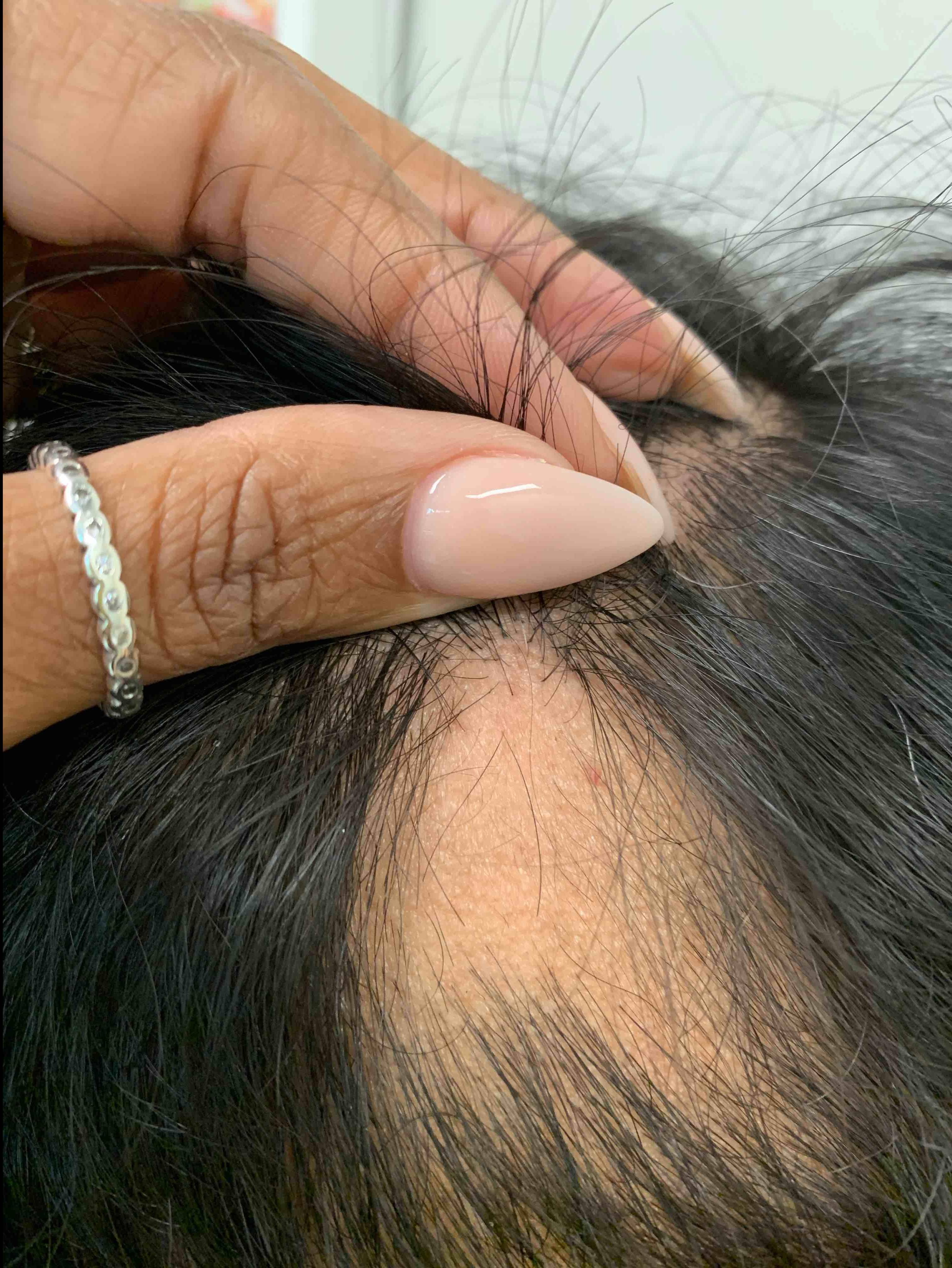 Hair Loss Before and After Case- 22 Before