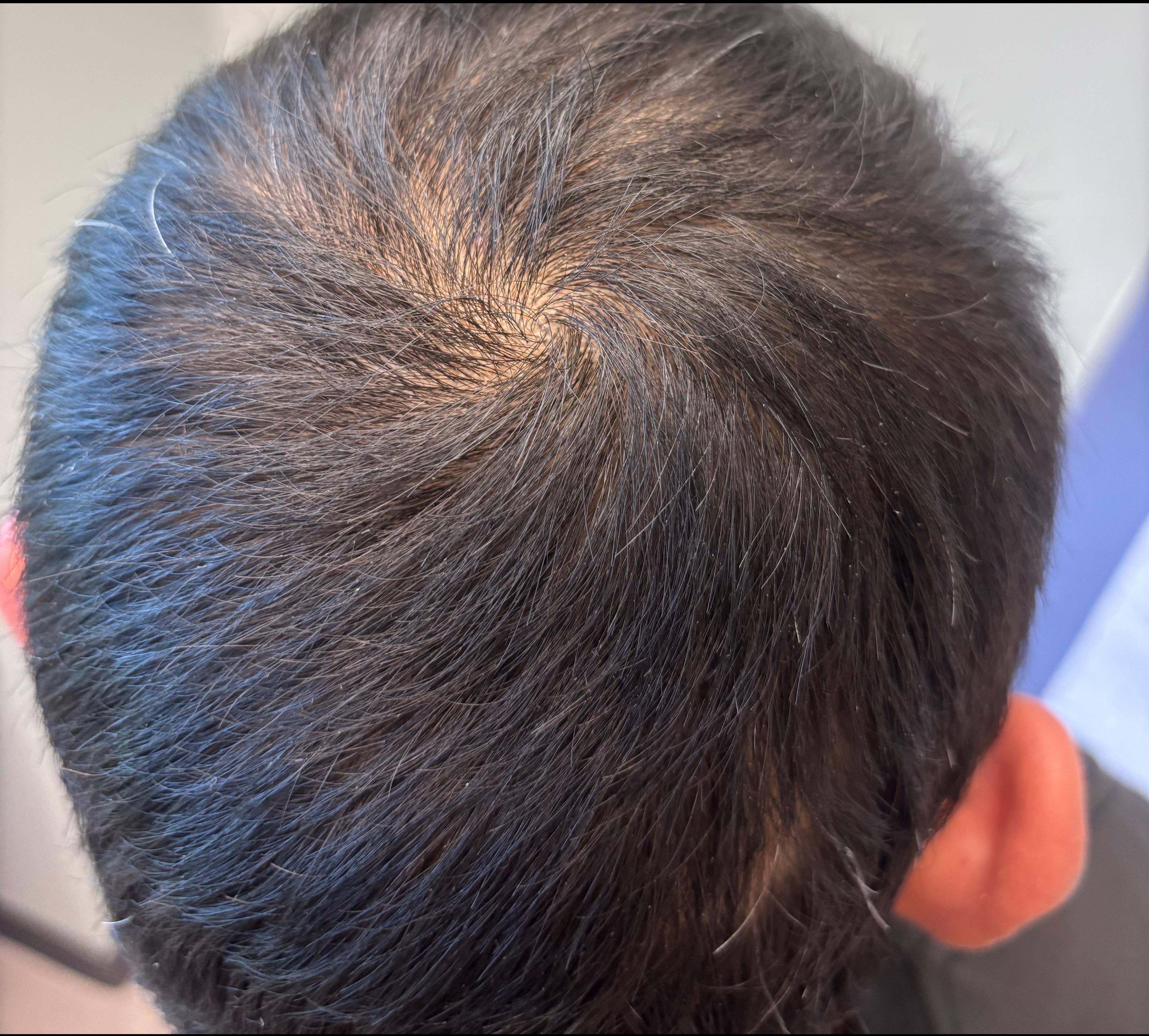 Hair Loss Before and After Case- 22 After