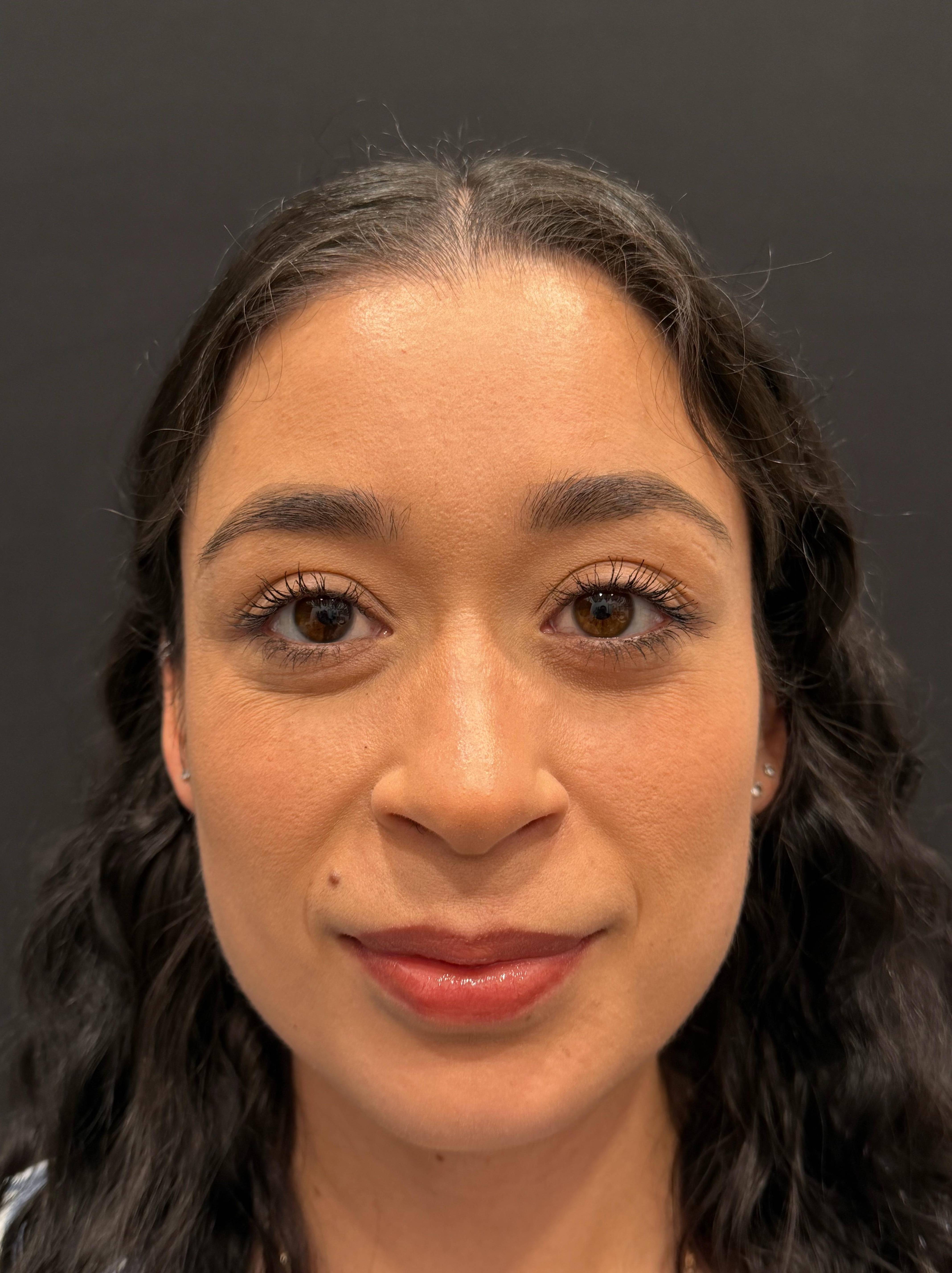 Botox Before and After Case- 25 Before