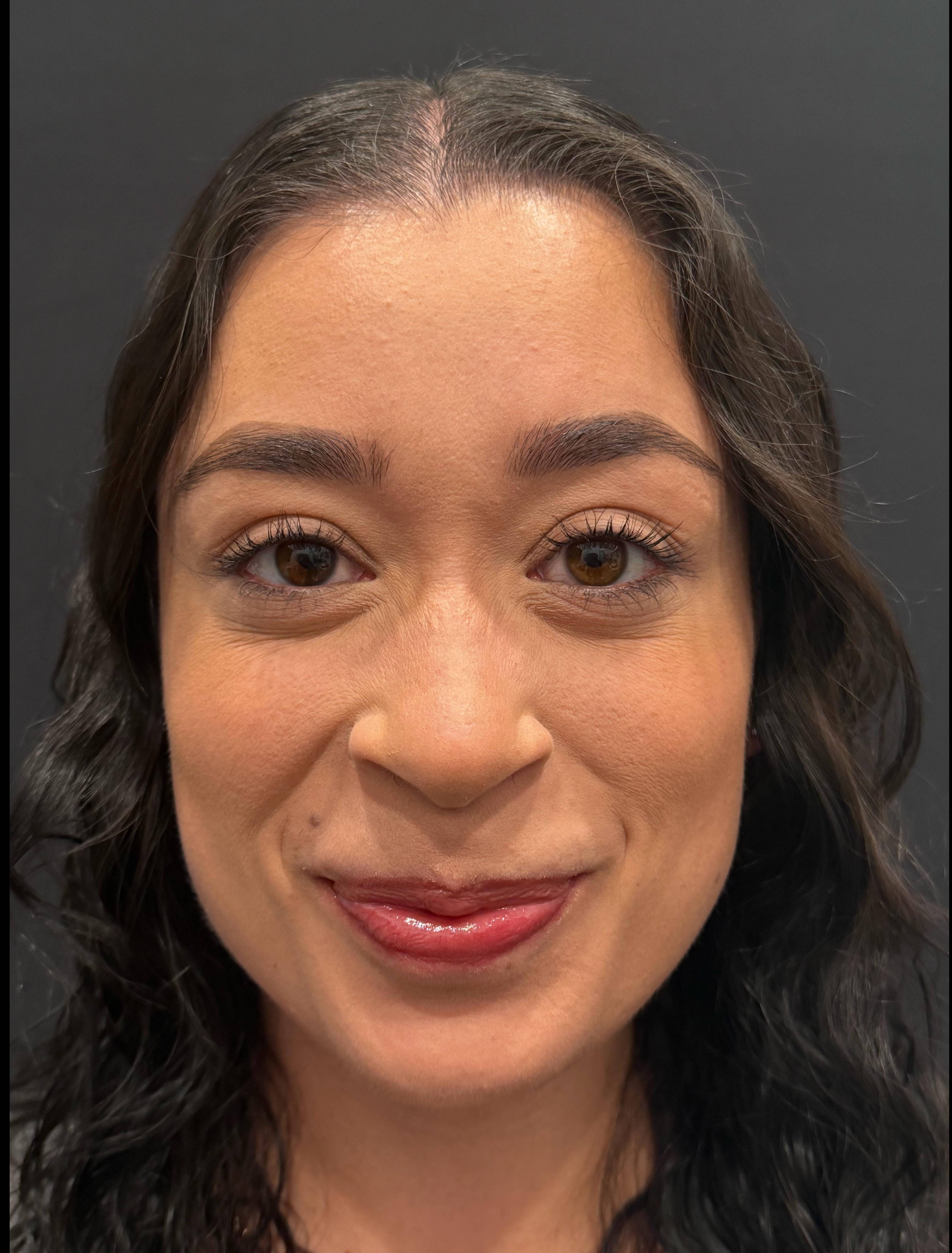 Botox Before and After Case- 25 After