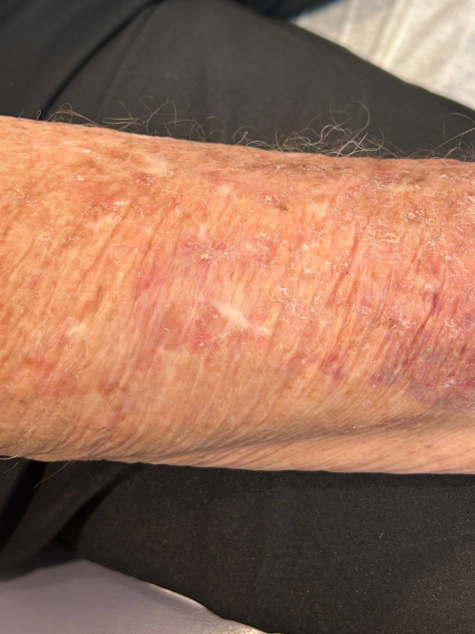 Cyst Removal Before and After Case- 81 After