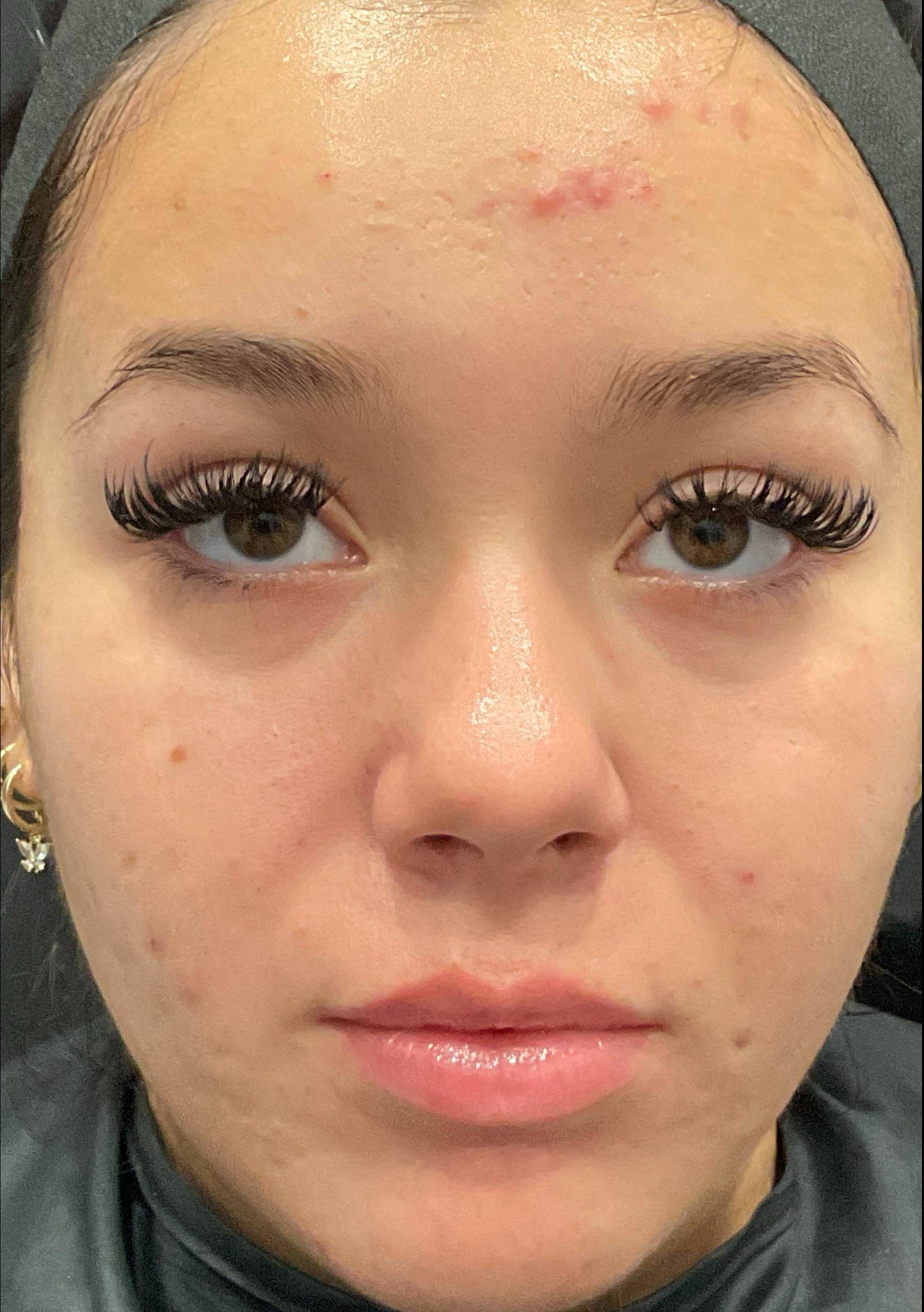 Acne Before and After Case 38 Before