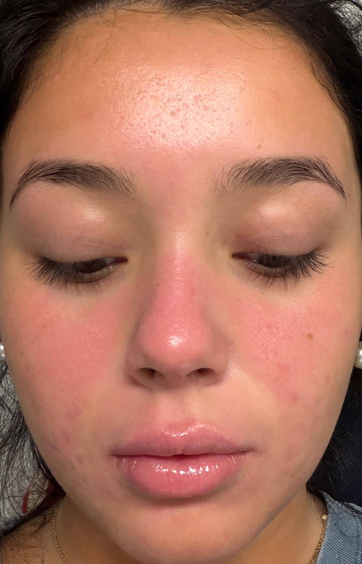 Acne Before and After Case 38 After
