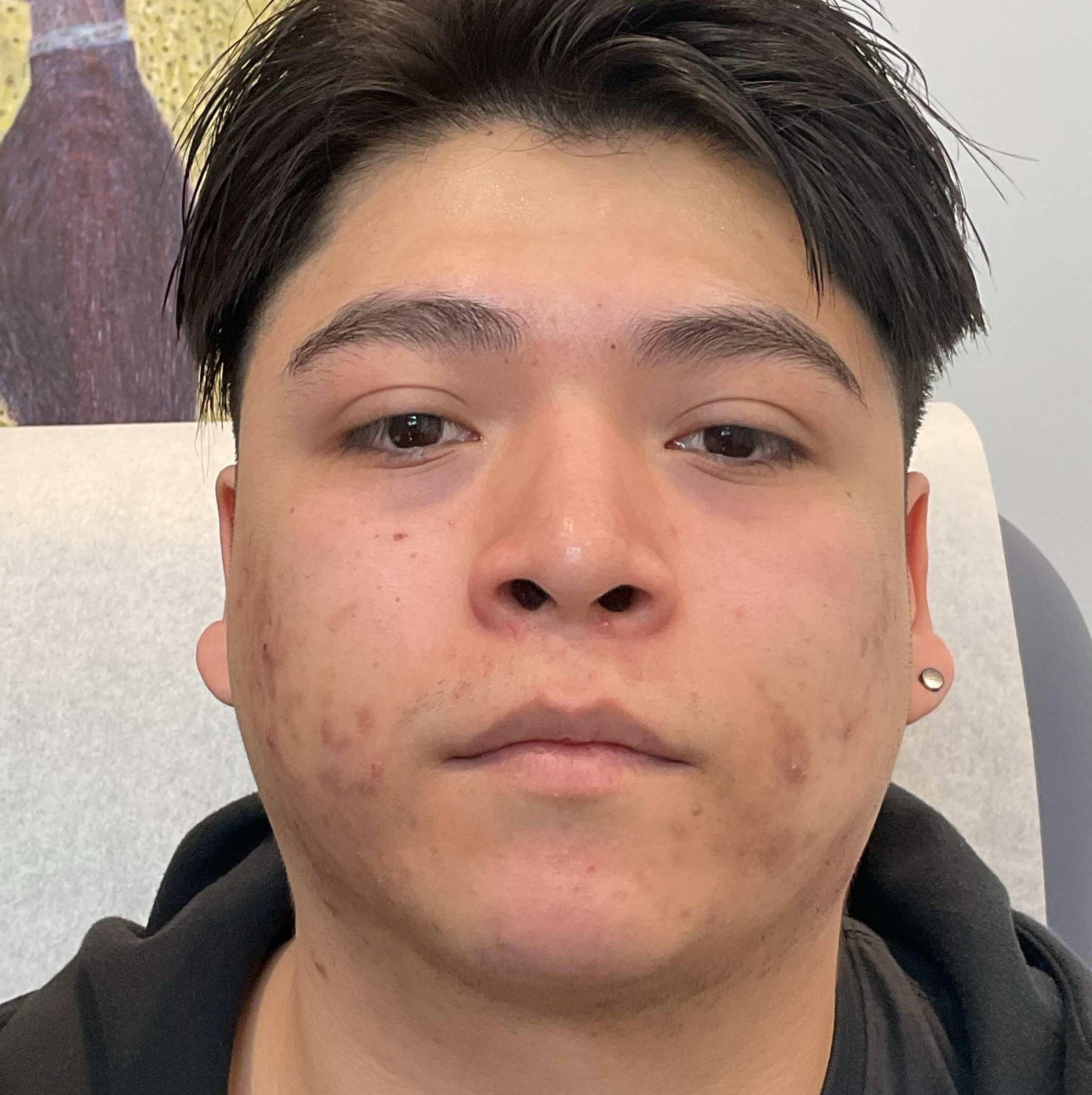 Acne Before and After Case 39 Before