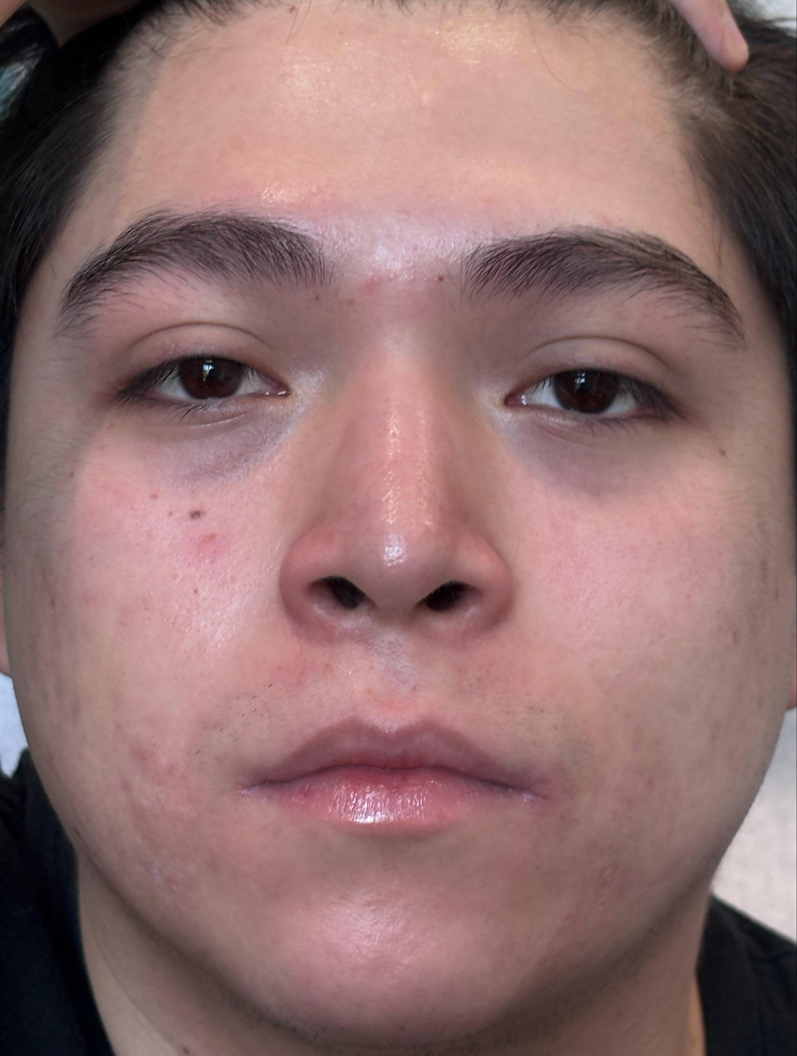 Acne Before and After Case 39 After