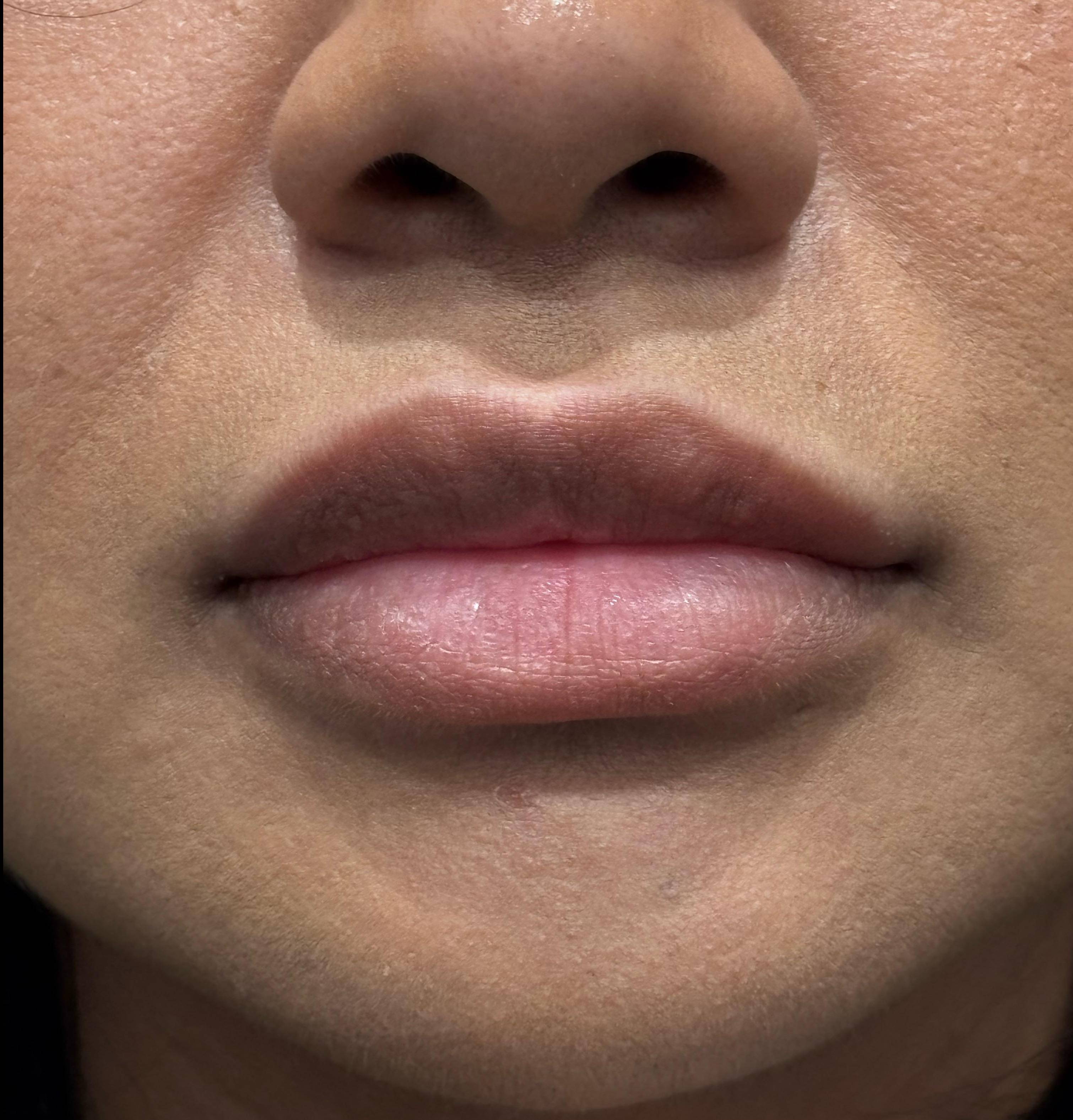 Restylane Before and After Case- 27 Before Restylane Before and After Case- 27 Before
