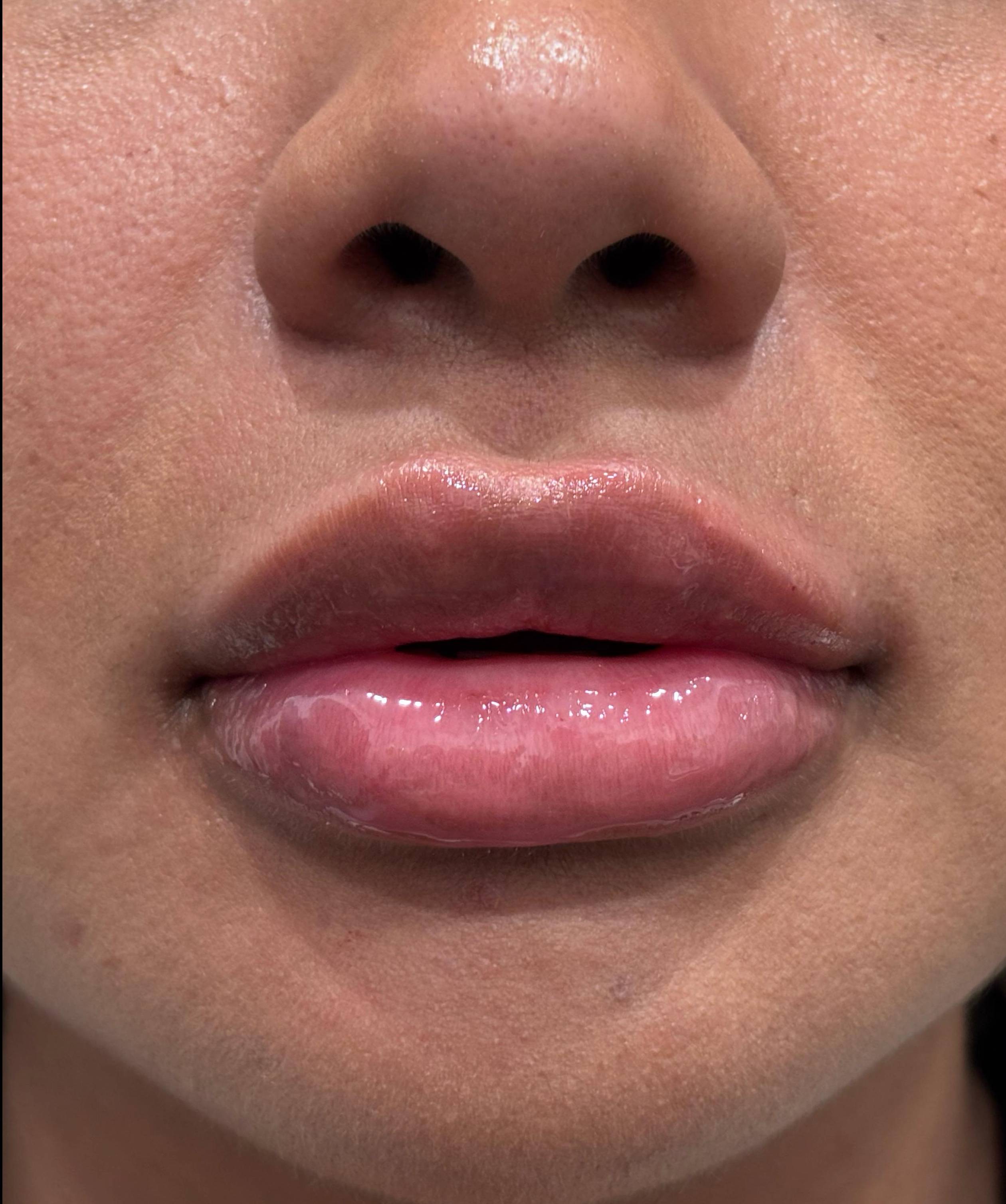 Restylane Before and After Case- 27 After Restylane Before and After Case- 27 After