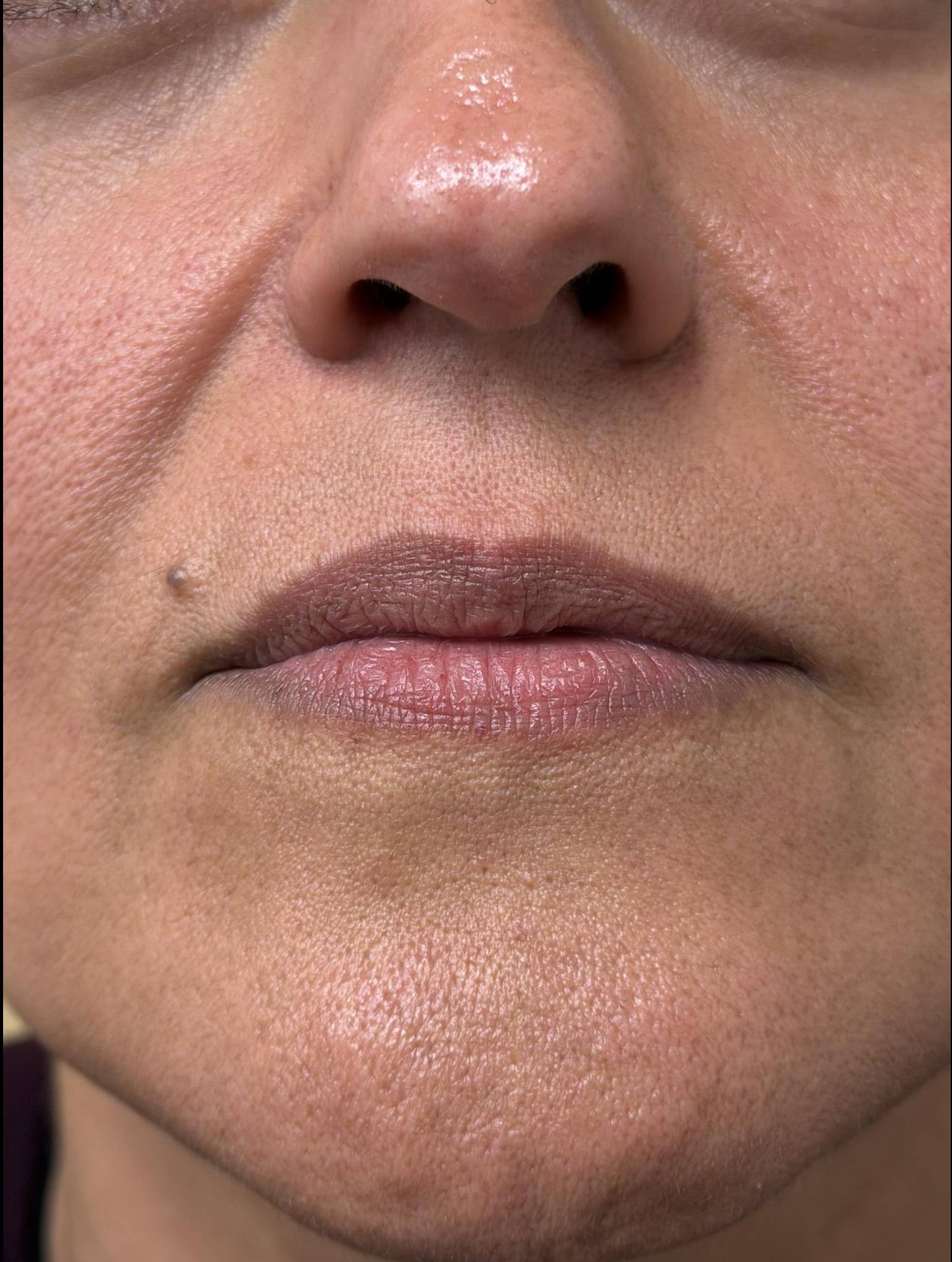 Restylane Before and After Case- 28 Before Restylane Before and After Case- 28 Before