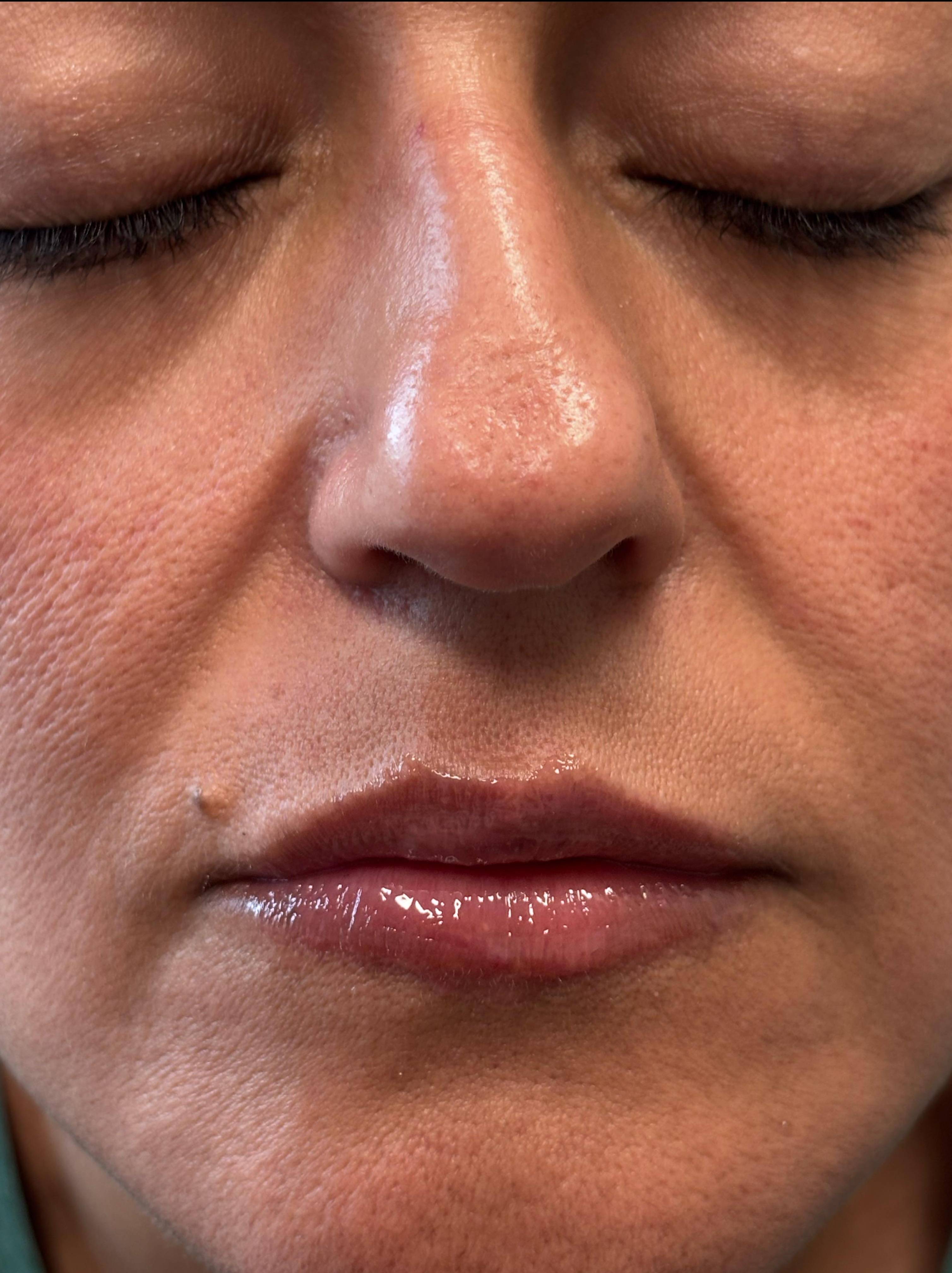 Restylane Before and After Case- 28 After Restylane Before and After Case- 28 After