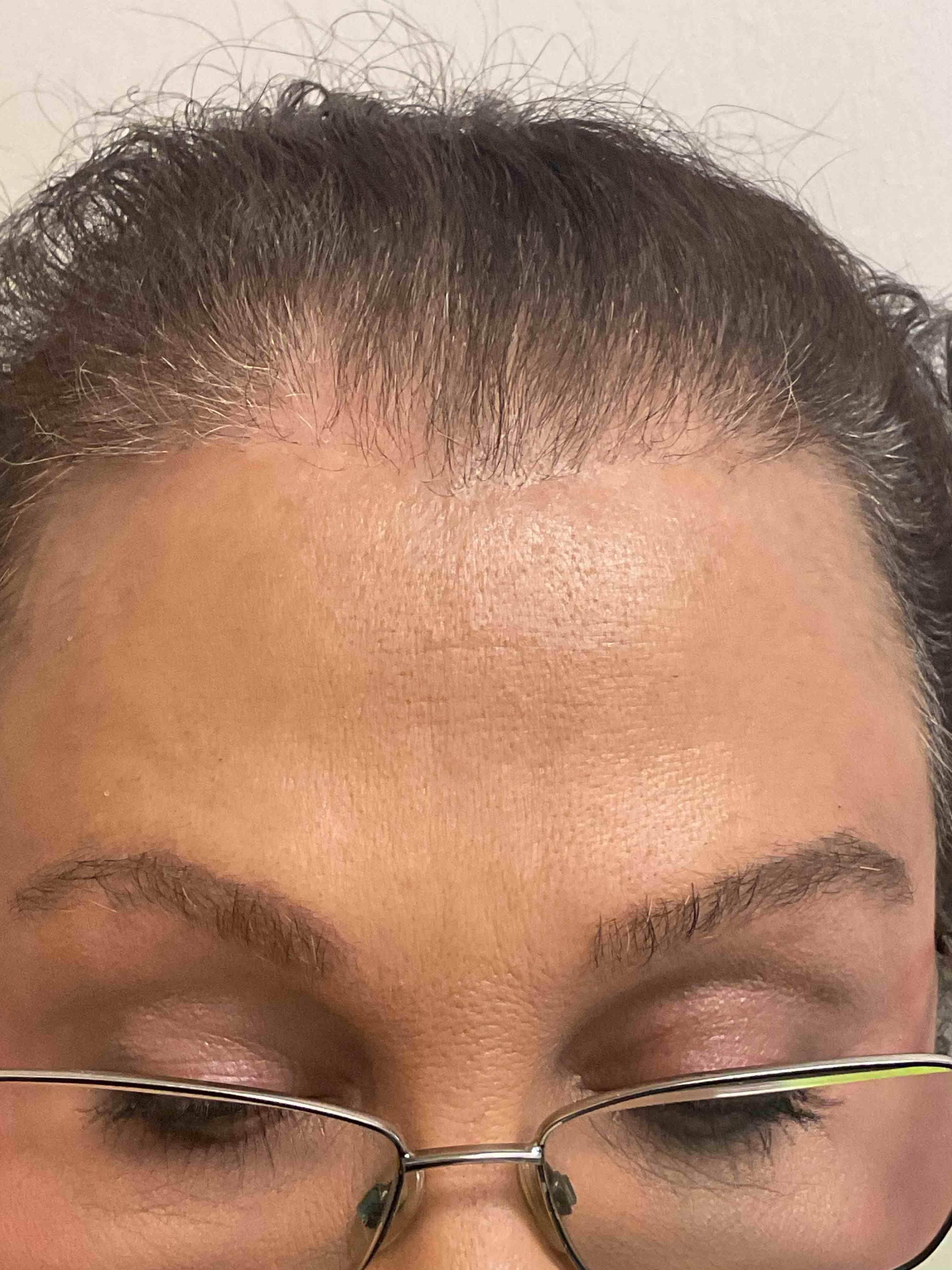 Hair Loss Before and After Case- 23 Before Hair Loss Before and After Case- 23 Before