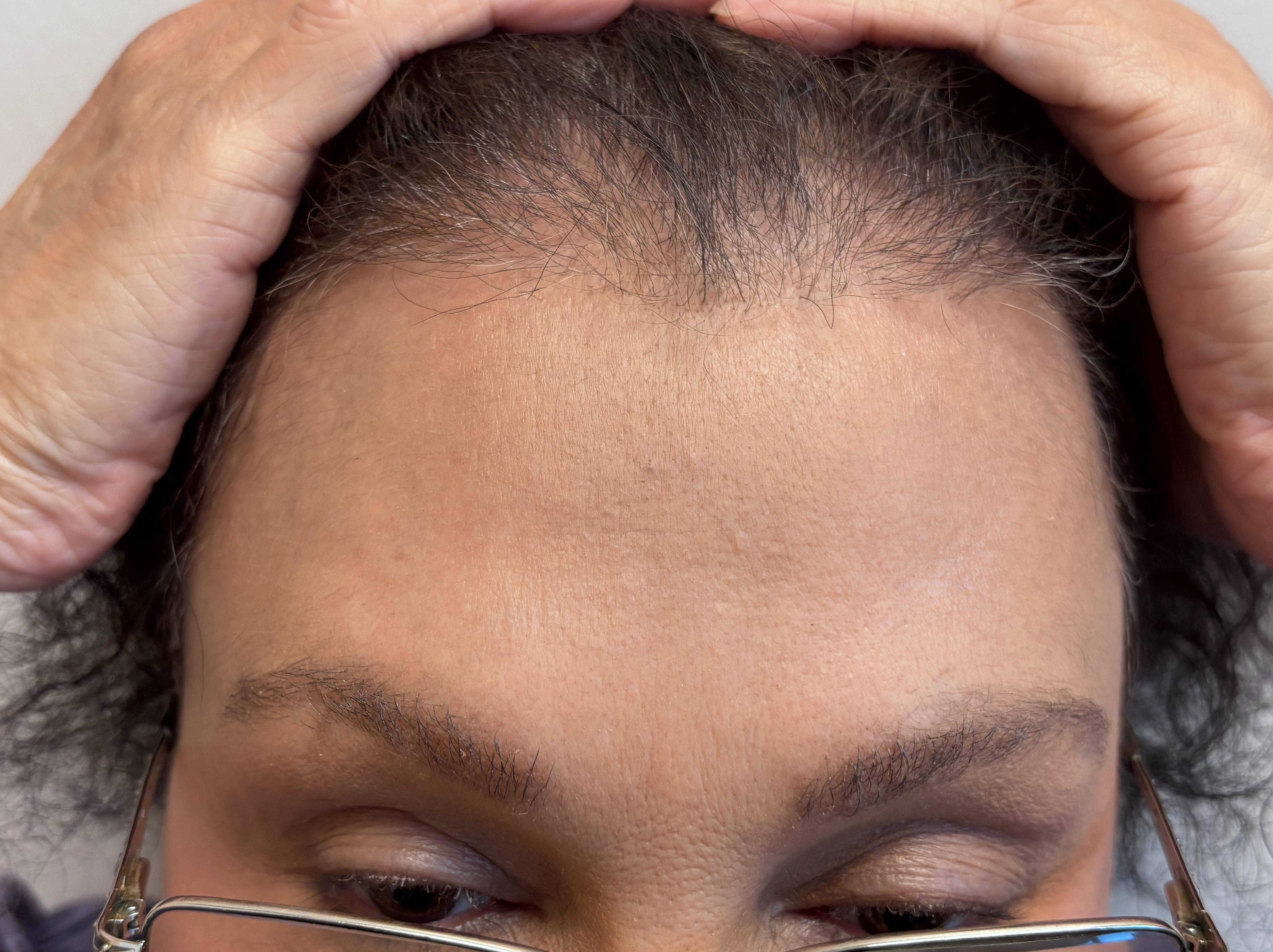 Hair Loss Before and After Case- 23 After Hair Loss Before and After Case- 23 After