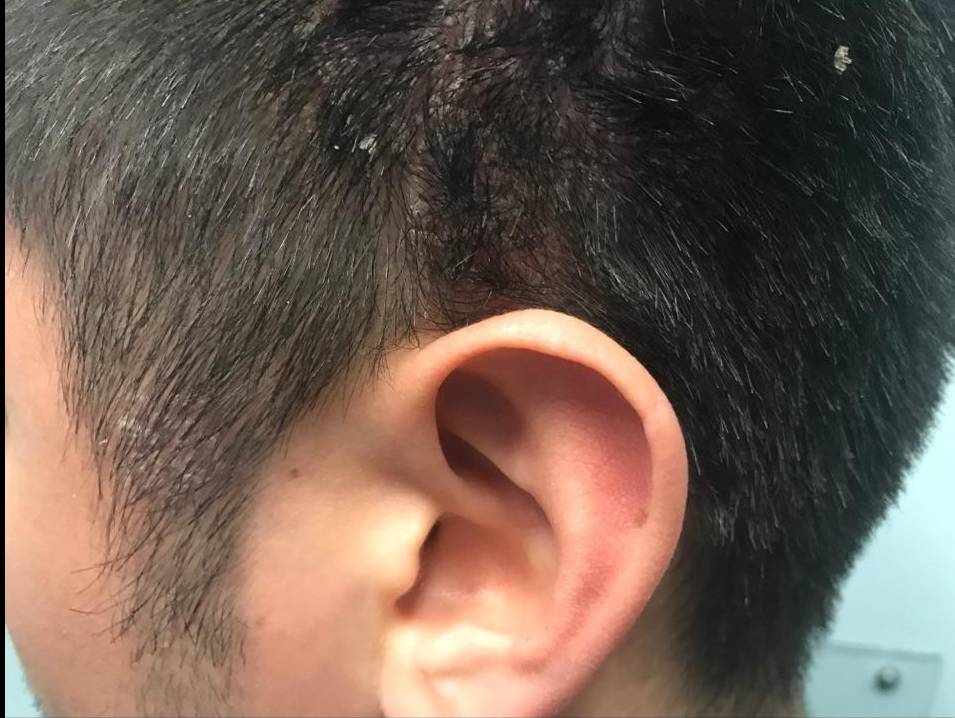 Psoriasis Before and After Case 14 Before