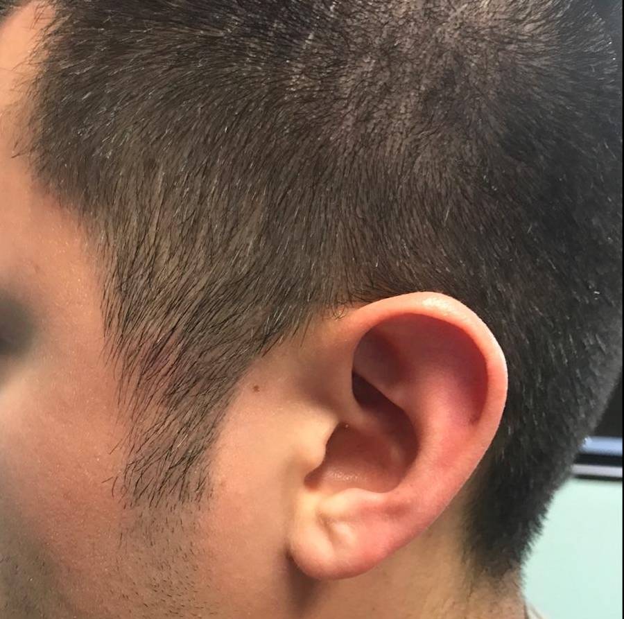 Psoriasis Before and After Case 14 After