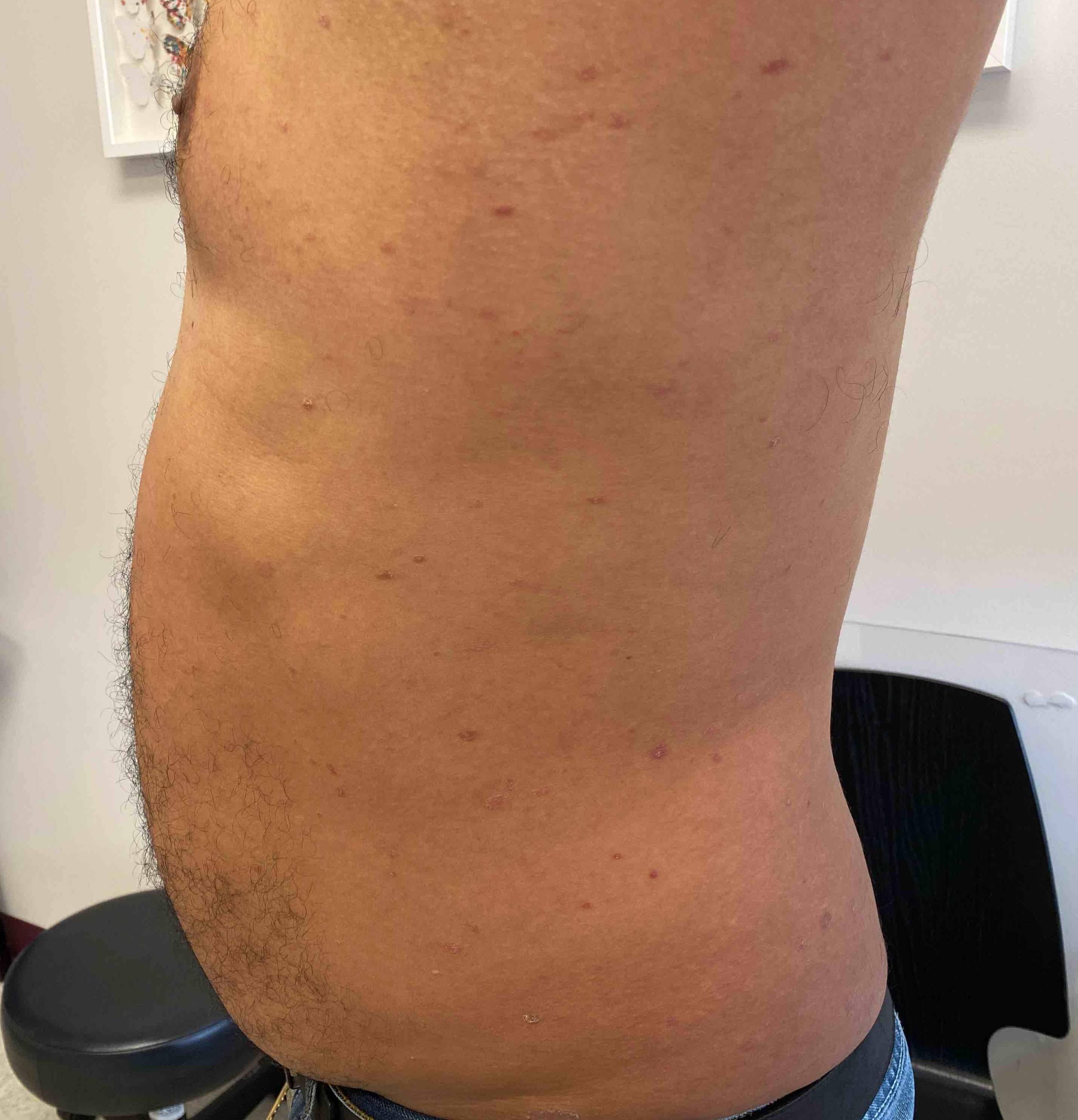 Psoriasis Before and After Case 15 Before