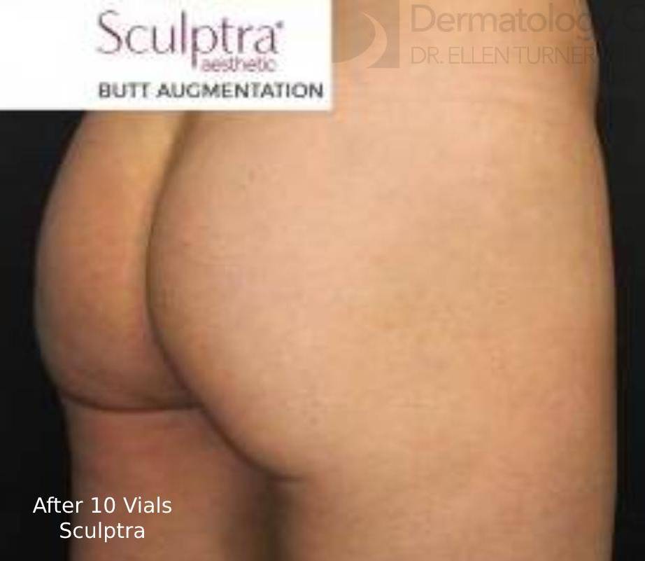 Sculptra (10 Vials) Before and After Case 2 After