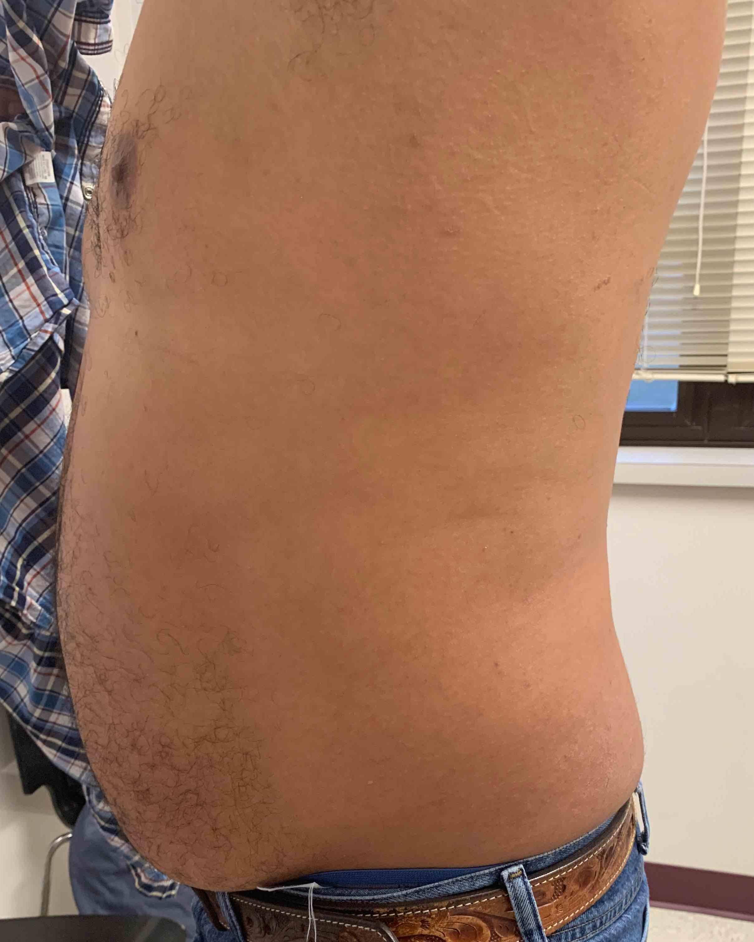 Psoriasis Before and After Case 15 After
