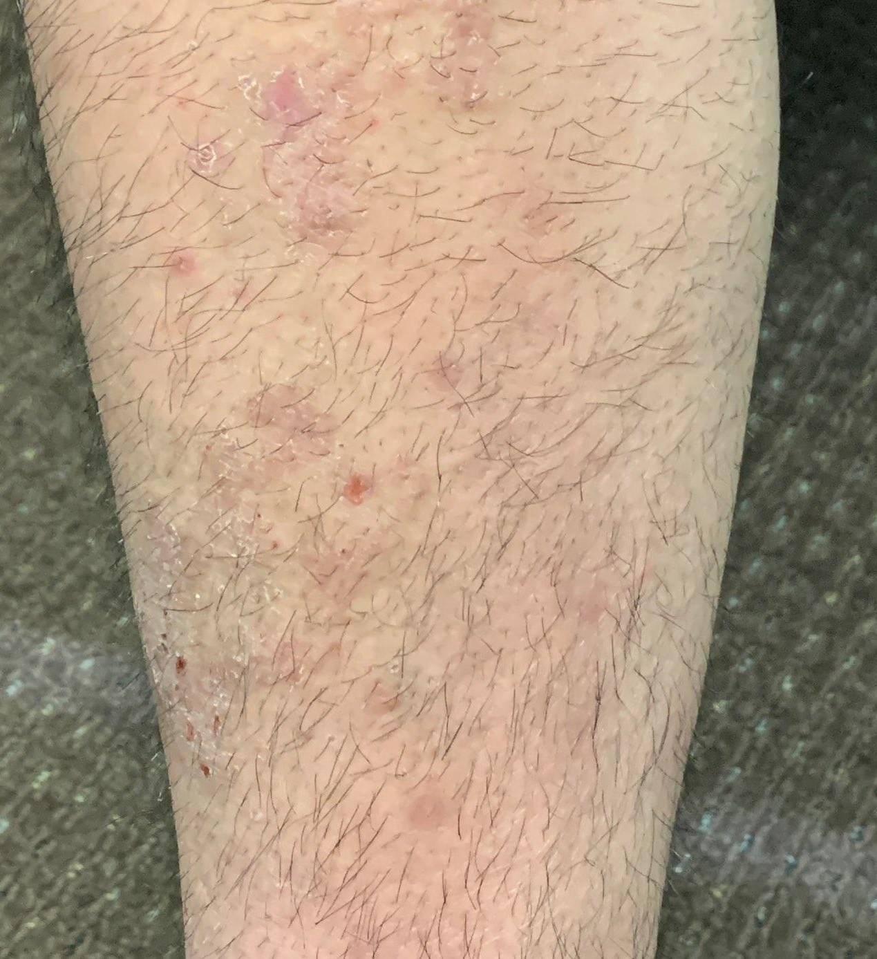 Psoriasis Before and After Case 17 Before