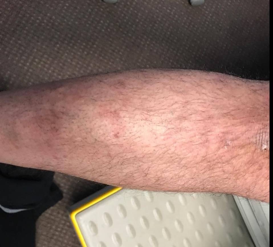 Psoriasis Before and After Case 18 After