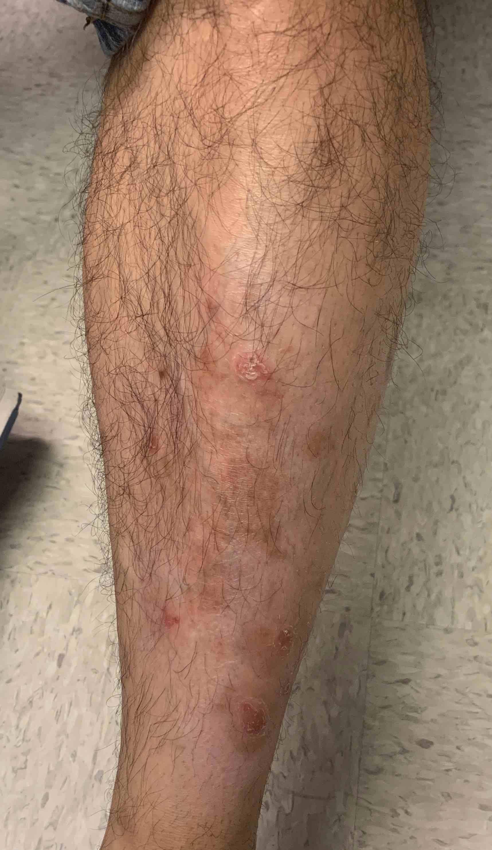 Psoriasis Before and After Case 19 Before