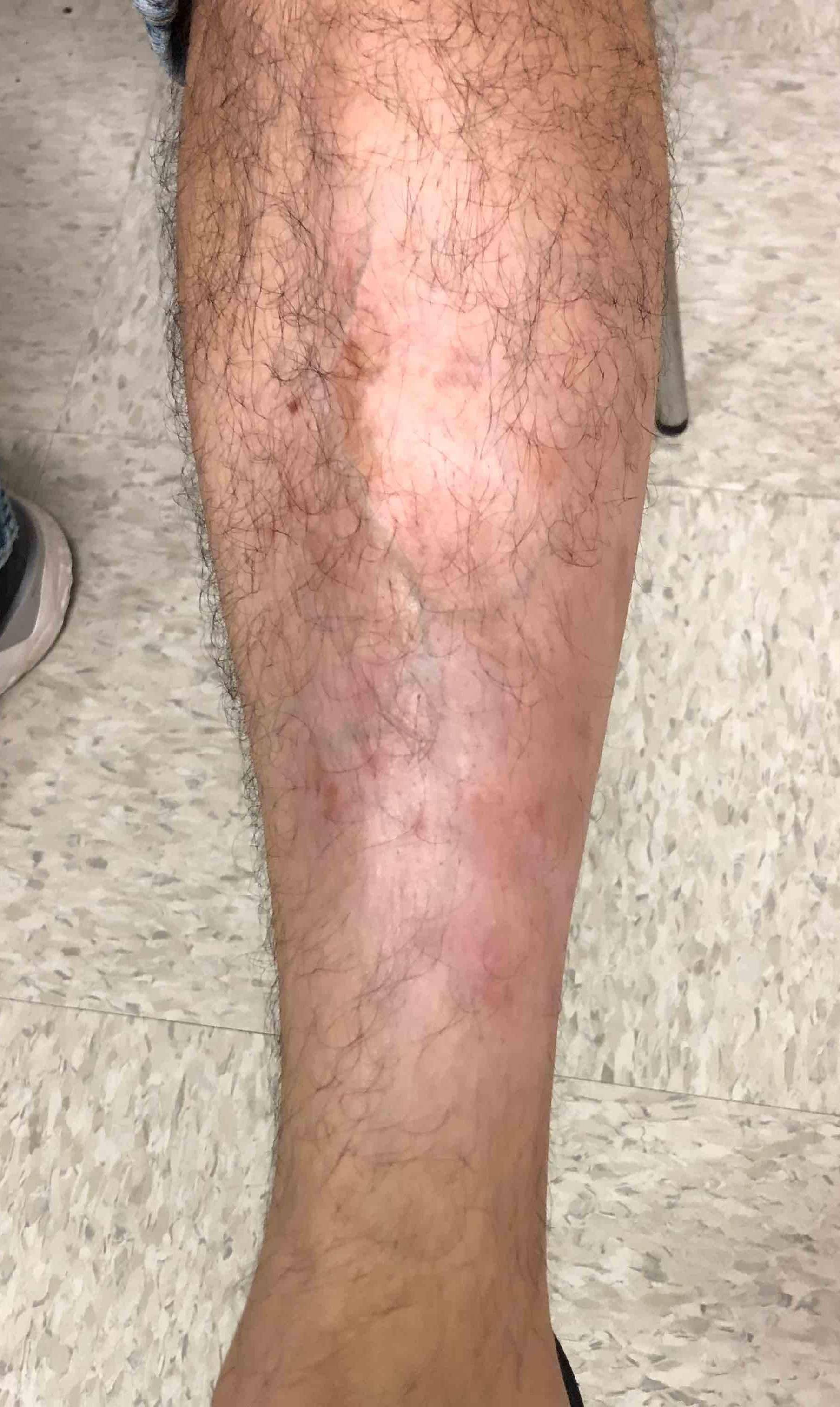 Psoriasis Before and After Case 19 After