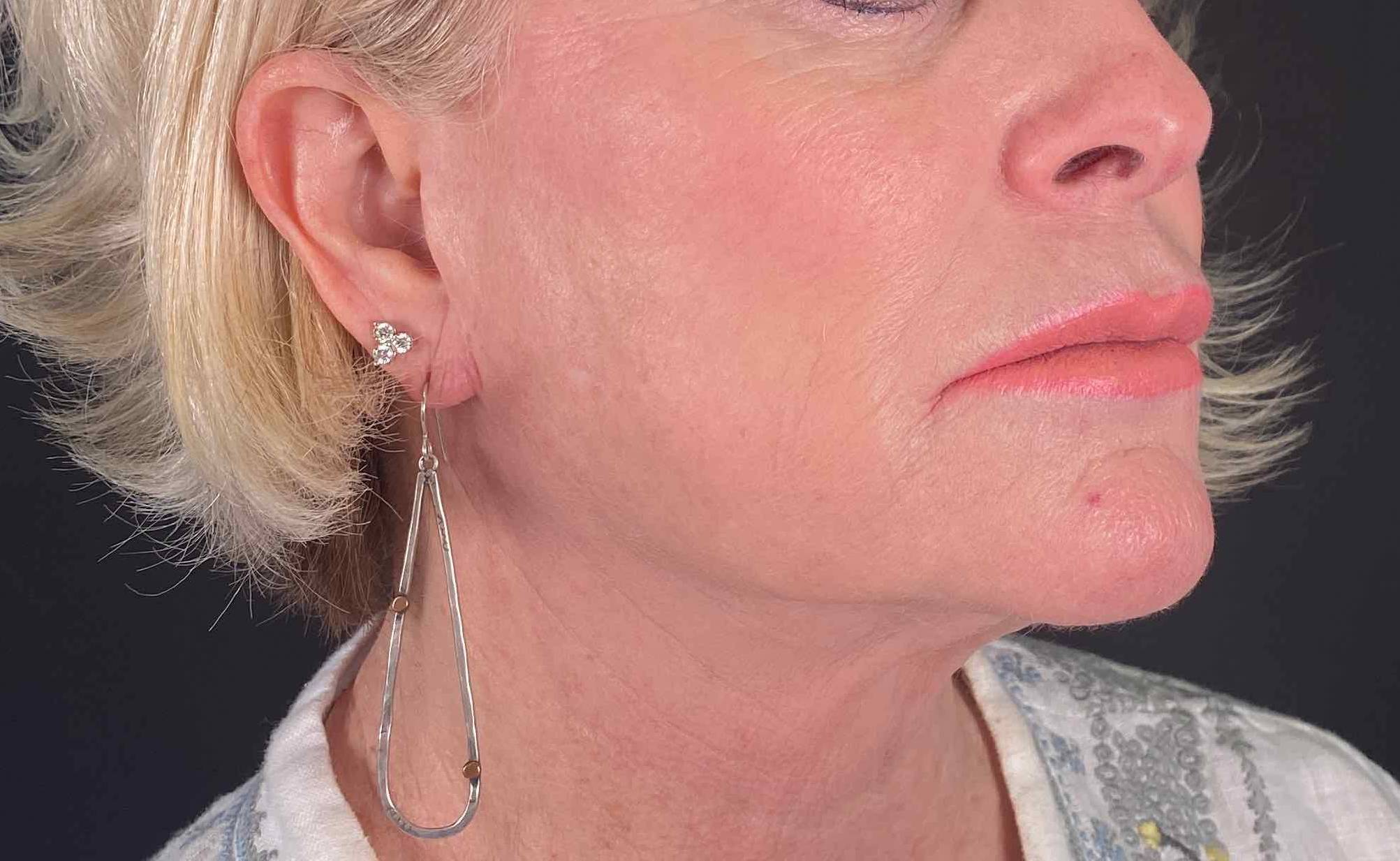 Silhouette Instalift Before and After Case 2 After