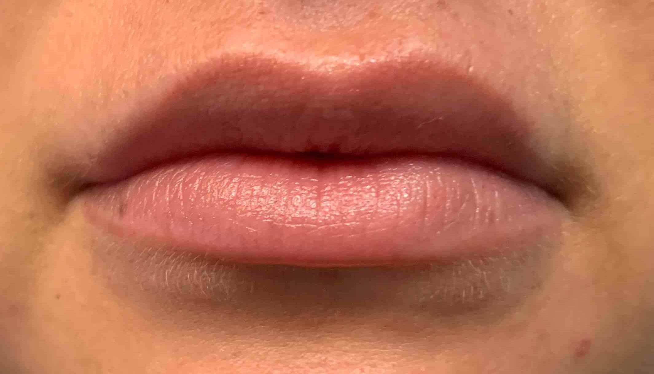 Volbella (1 syringe) Before and After Case 4 After