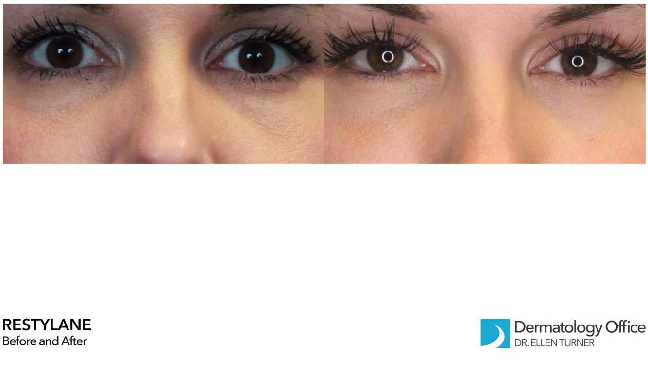 Restylane Before and After Case 5 
