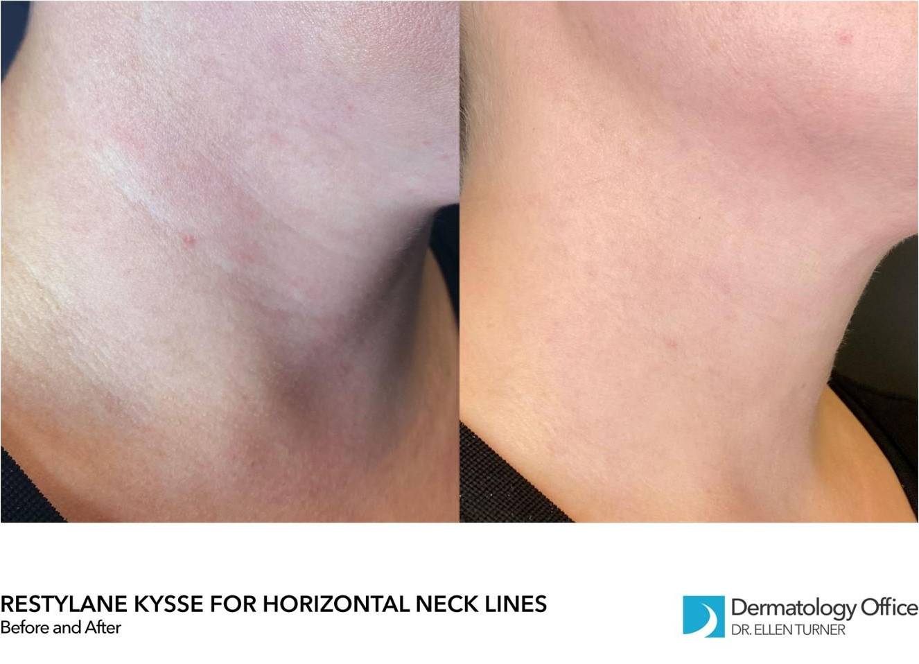 Restylane Before and After Case 6 