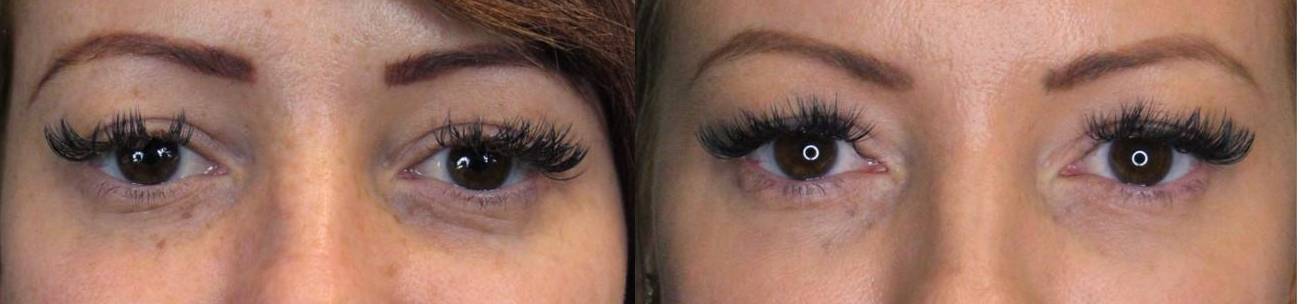 Restylane Before and After Case 7 