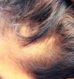 Platelet-Rich Plasma Before and After Case 1 Before