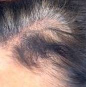 Platelet-Rich Plasma Before and After Case 1 After