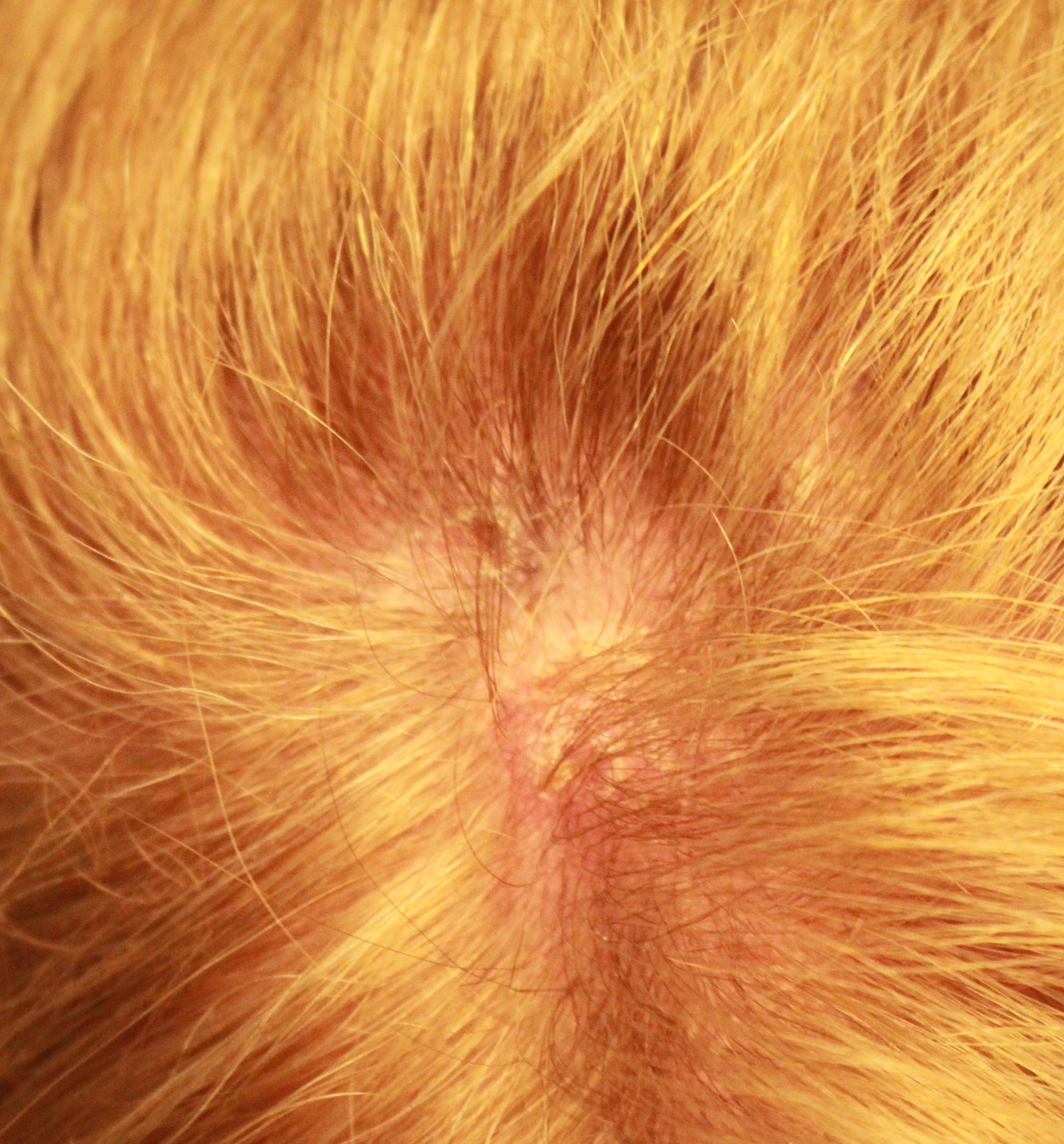 Psoriasis Before and After Case 21 Before