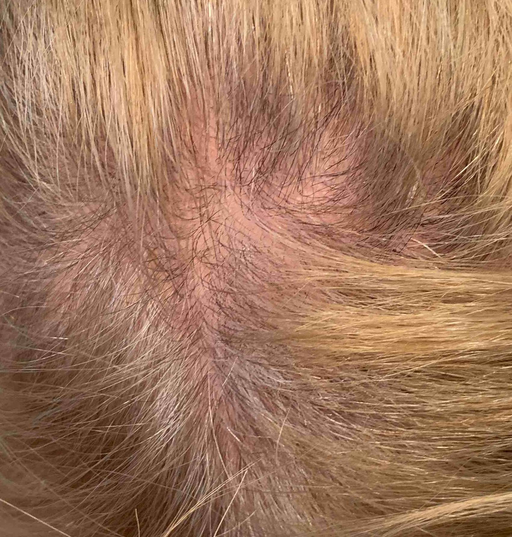 Psoriasis Before and After Case 21 After