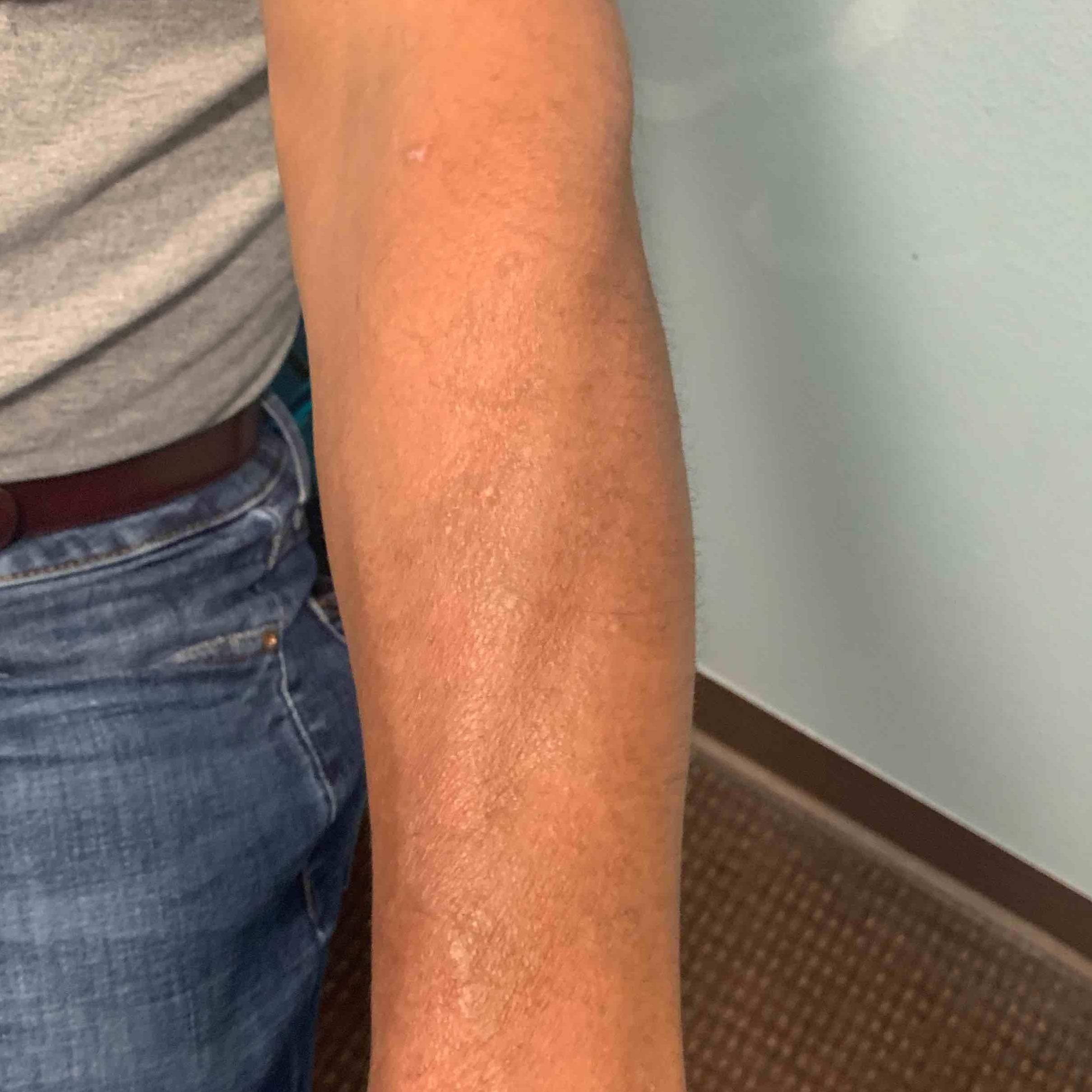 Psoriasis Before and After Case 22 After