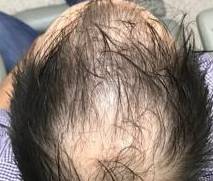 Platelet-Rich Plasma Before and After Case 2 Before