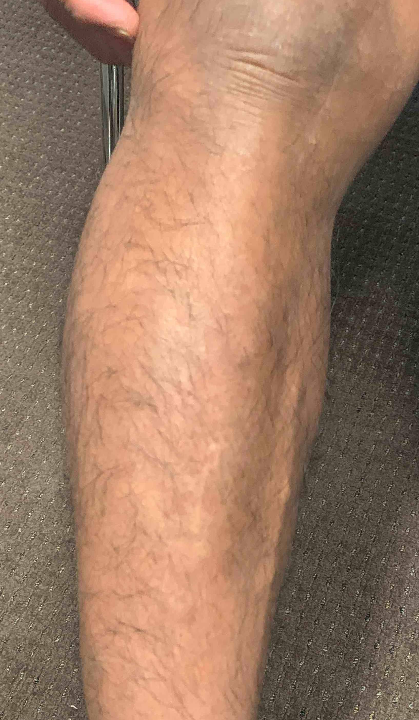 Psoriasis Before and After Case 23 After