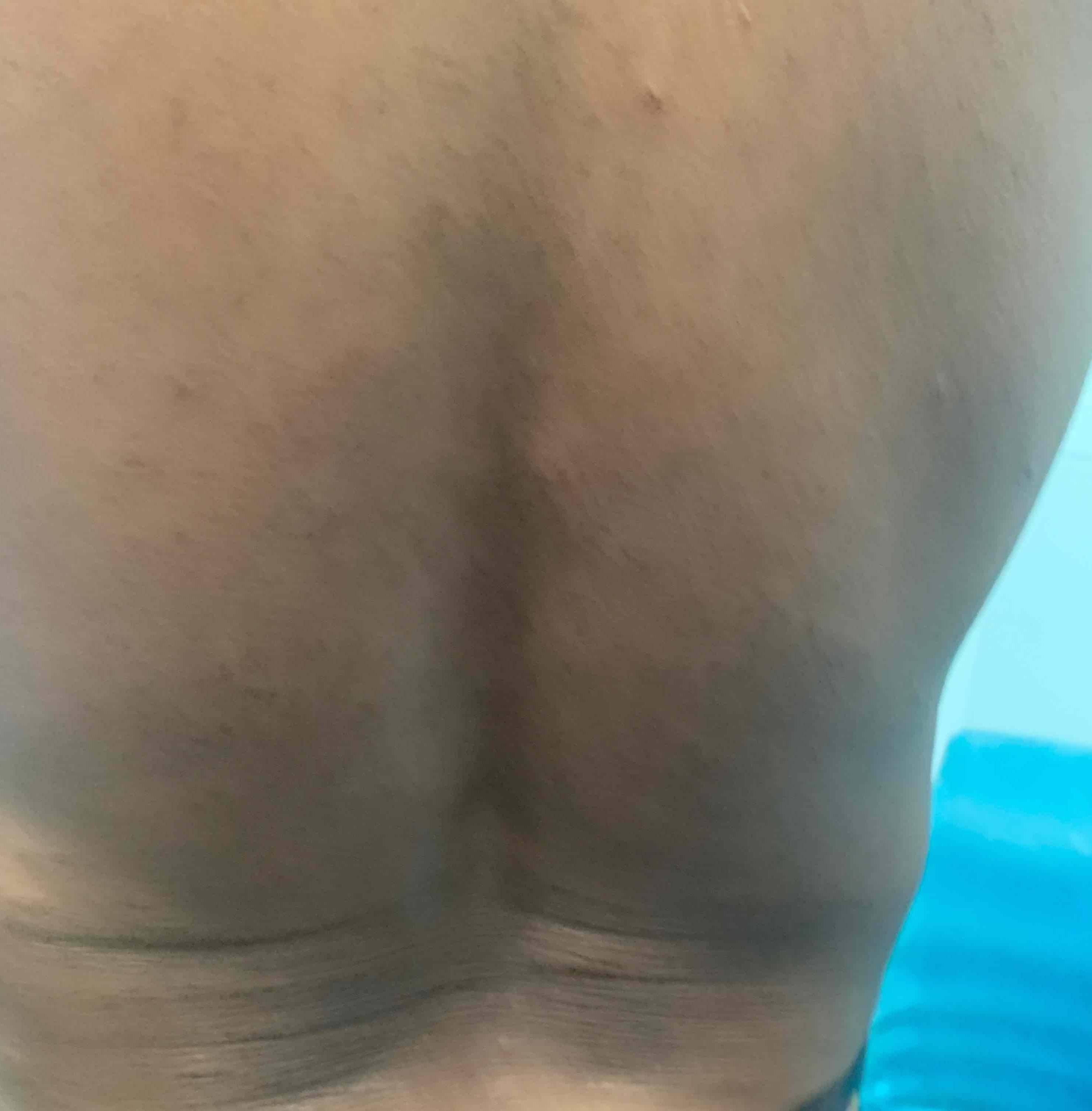 Psoriasis Before and After Case 24 After