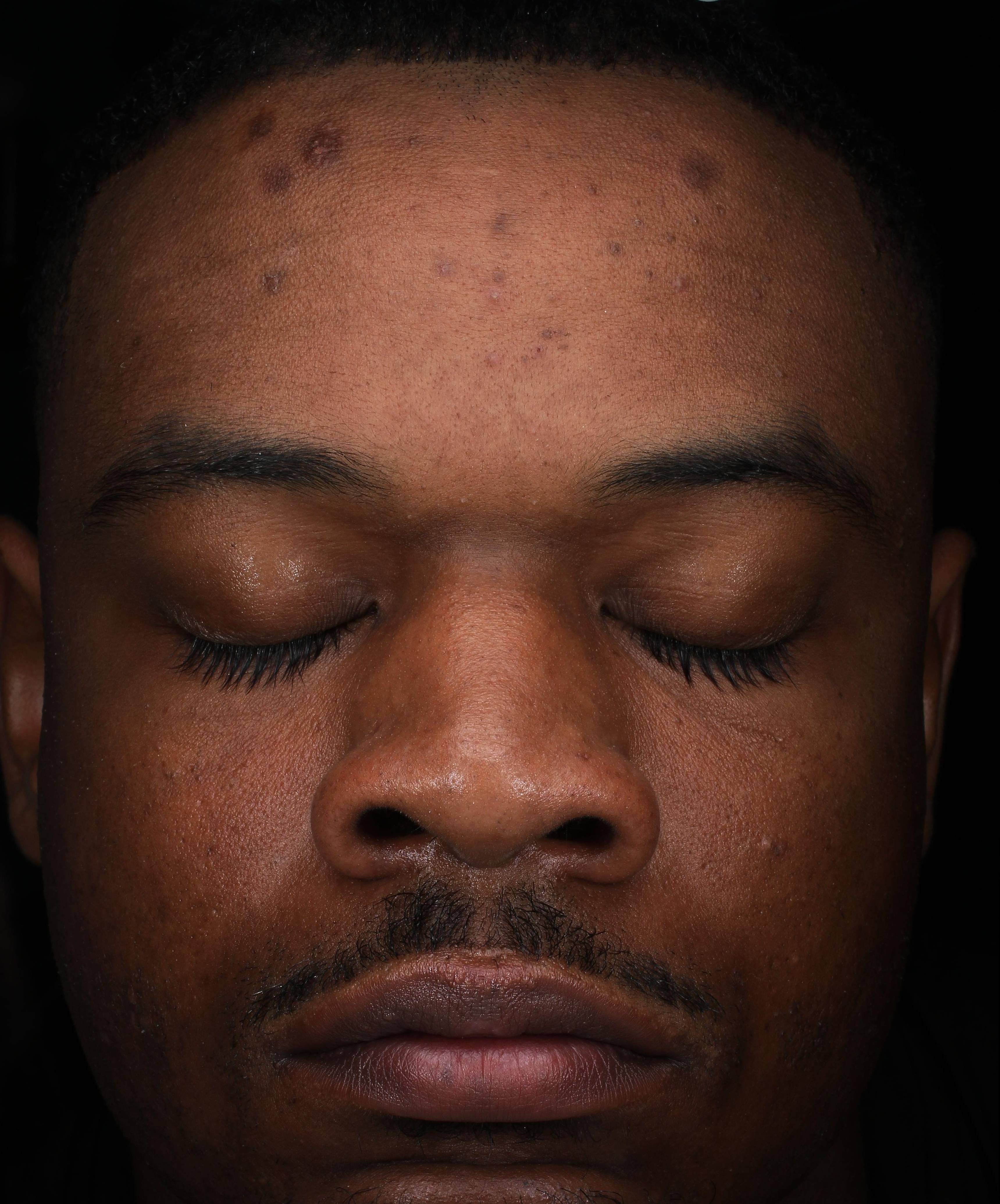 Picocare 450 Before and After Case 4 Before