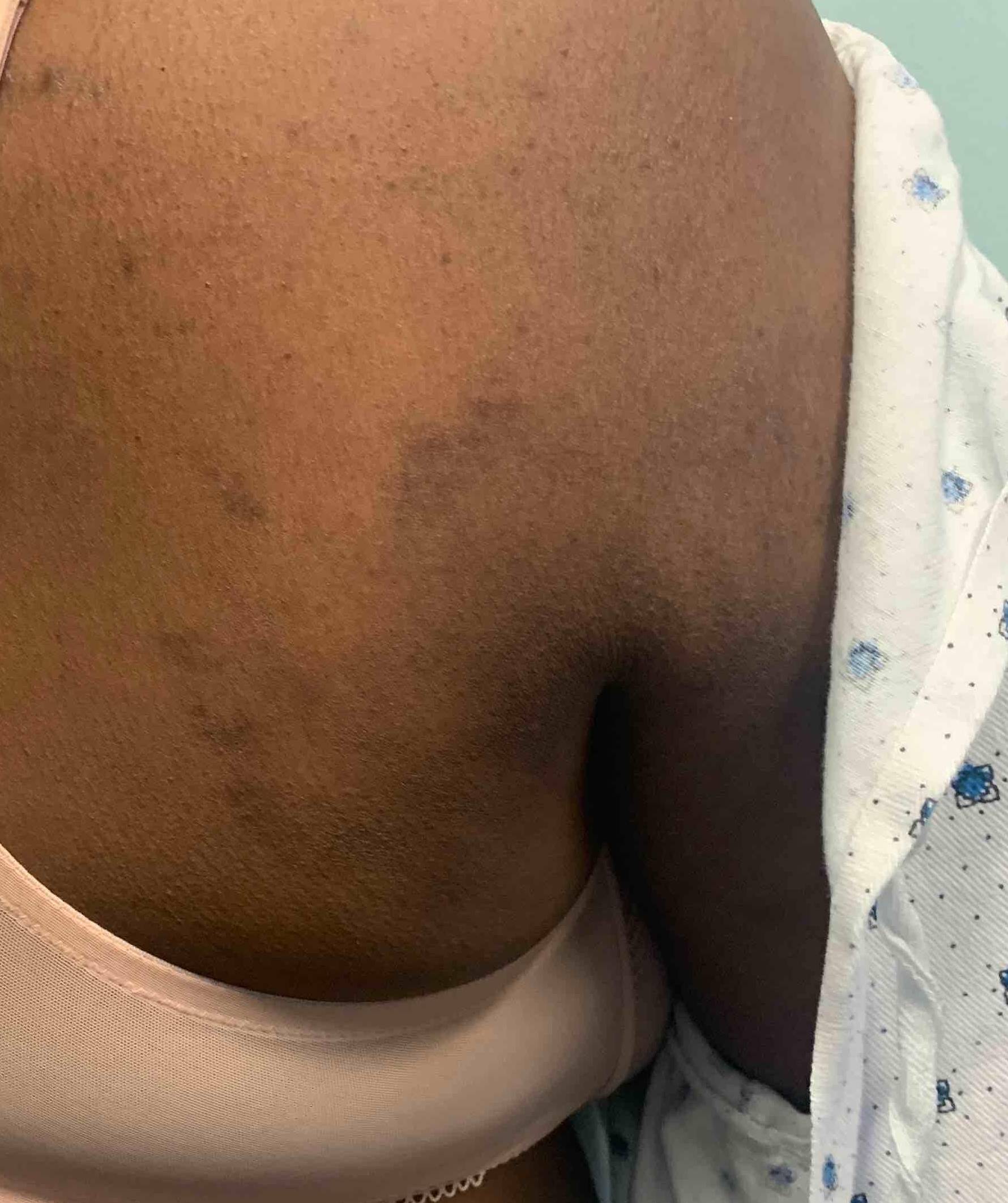 Psoriasis Before and After Case 25 Before