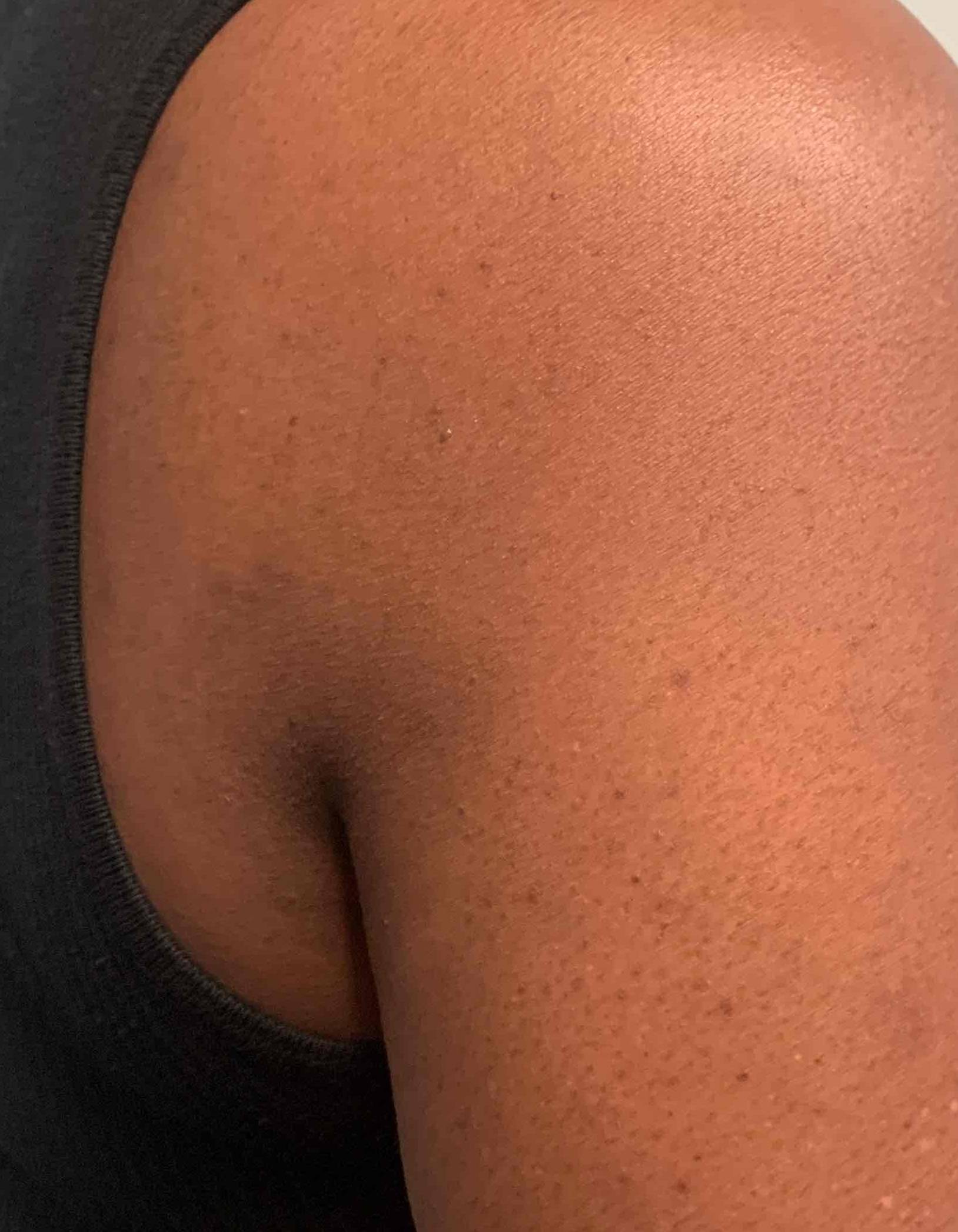 Psoriasis Before and After Case 25 After