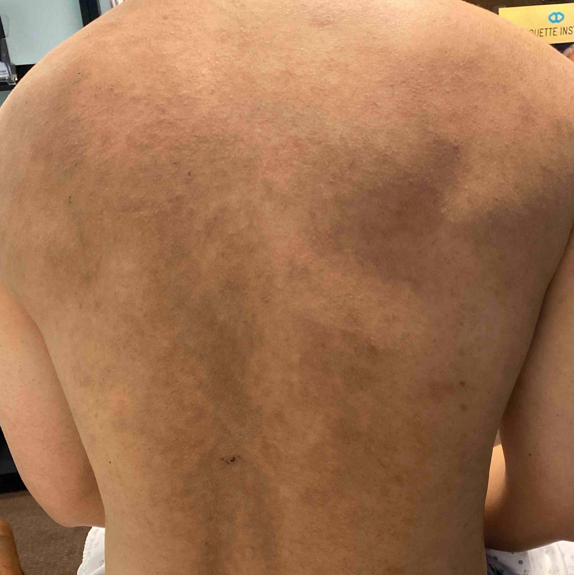 Eczema Before and After Case 8 Before