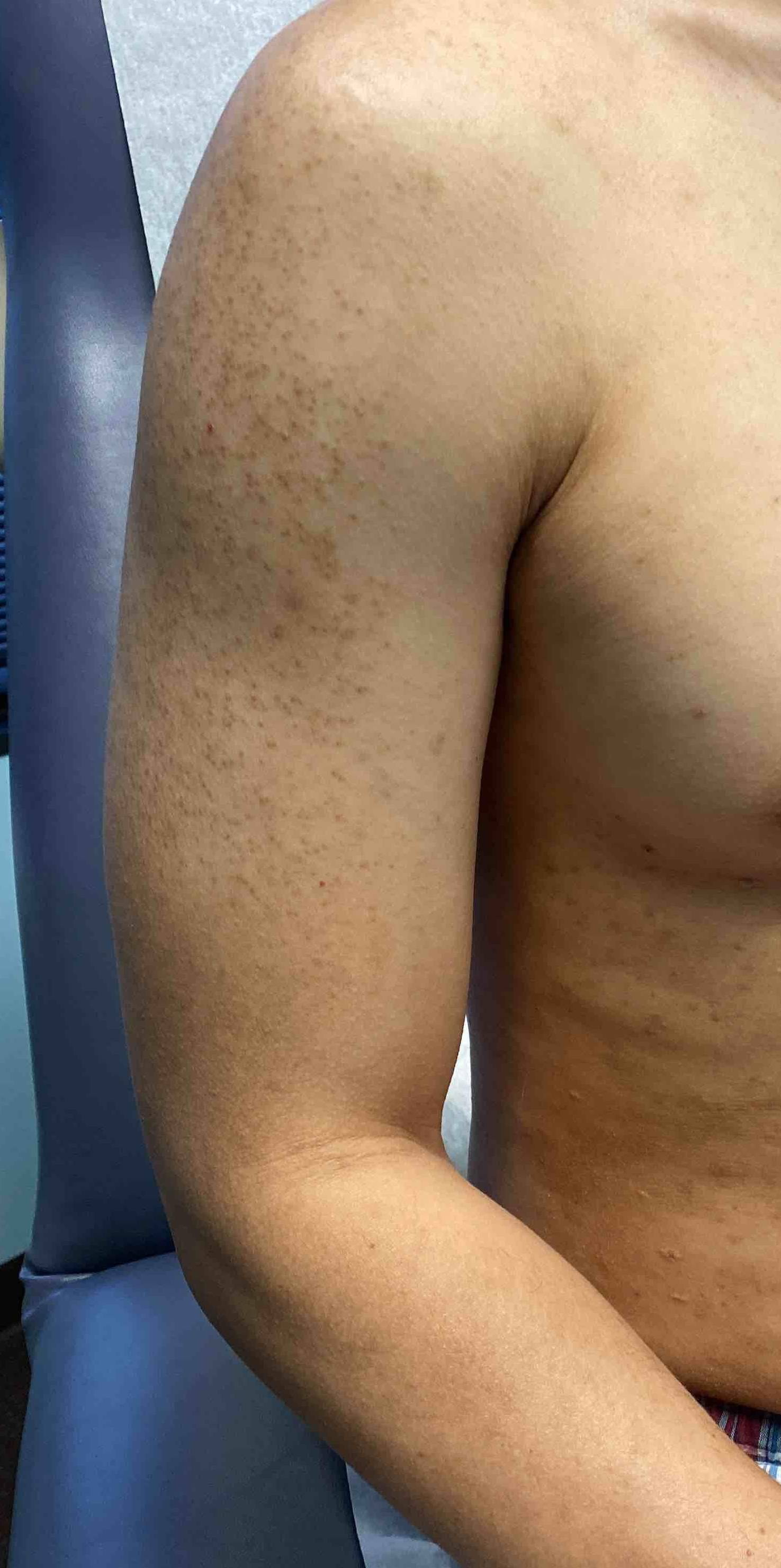 Eczema Before and After Case 9 Before